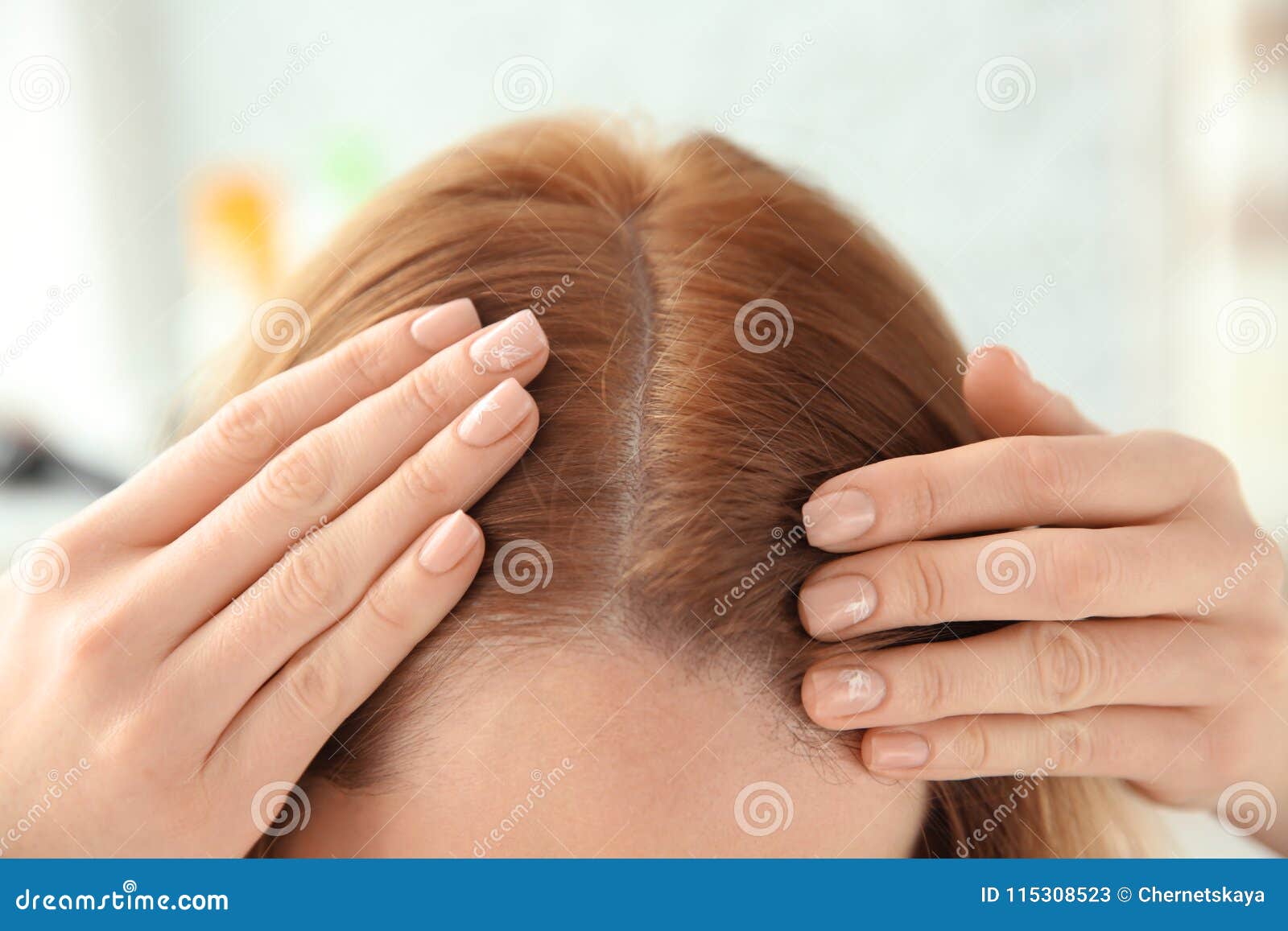Young Woman with Hair Loss Problem Stock Image Image of closeup, head