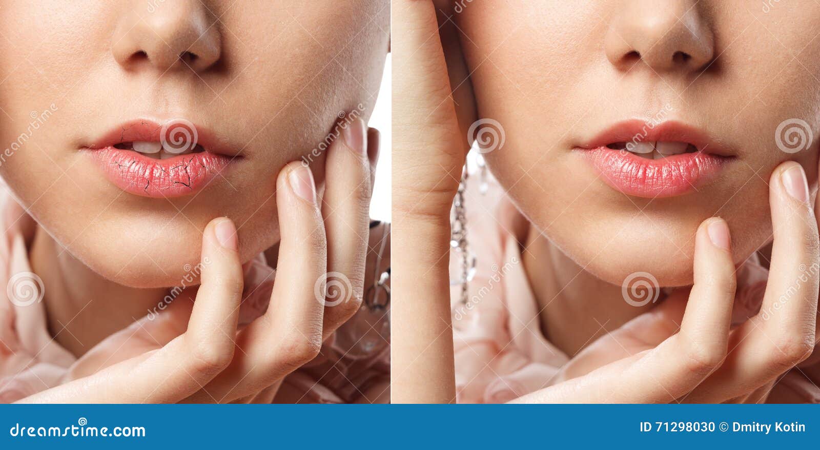 young woman has chapped lips