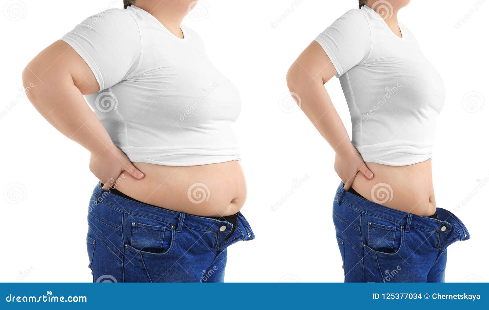 young woman before and after liposuction operation