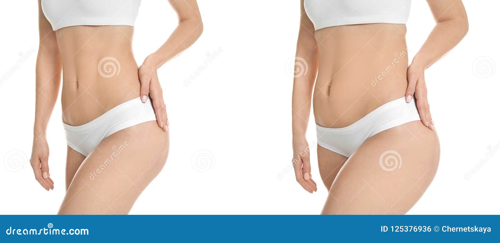 young woman before and after liposuction operation