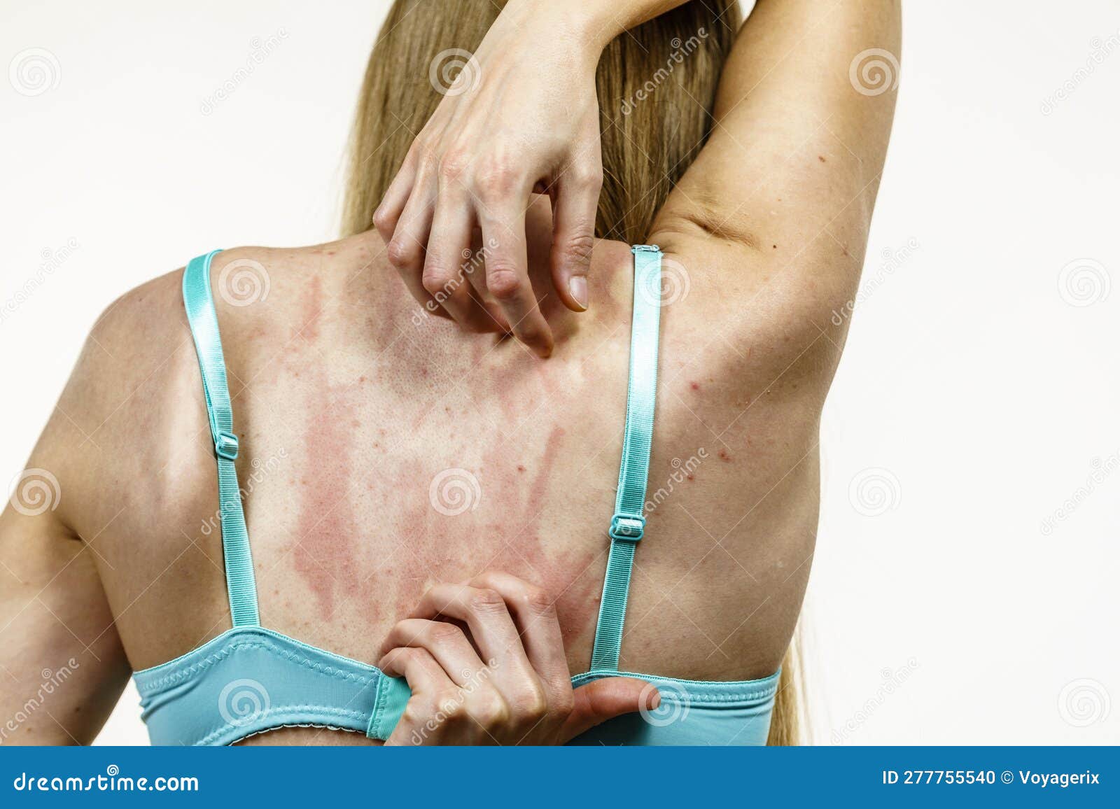 Woman Scratching Her Itchy Back with Allergy Rash Stock Photo - Image of  care, itchy: 277755540