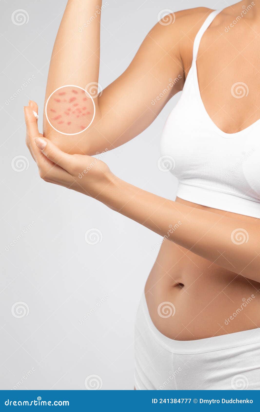 Young Woman in White Underwear Applies Ointment for the Rash To the Elbows.  Treatment of Dermatological Diseases Stock Image - Image of body,  dermatological: 241384777