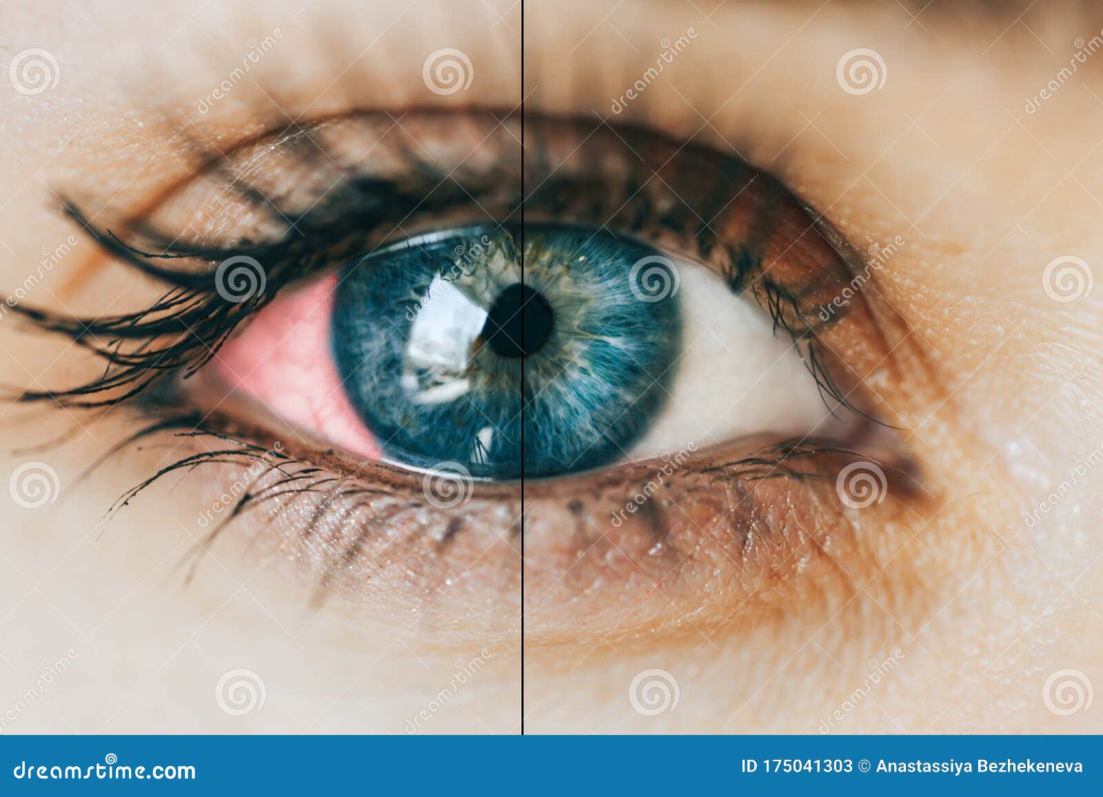 Doorlaatbaarheid Bewusteloos Injectie Zieke rode ogen stock afbeelding. Image of besmet, gevaar - 175041303 Doorlaatbaarheid Bewusteloos Injectie Zieke rode ogen stock afbeelding. Image of besmet, gevaar - 175041303