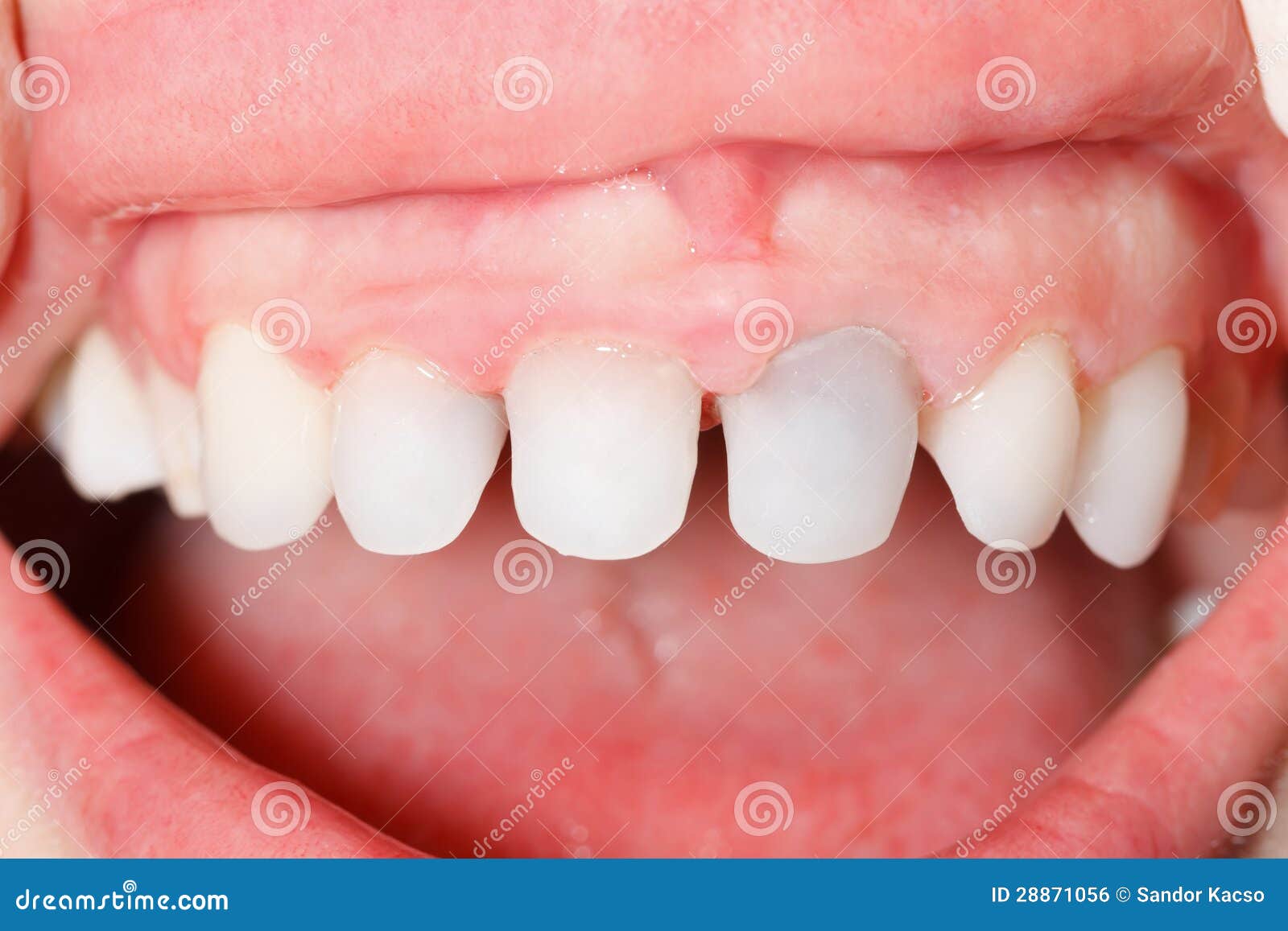 Zircon teeth stock photo. Image of medical, cavity, cast 28871056