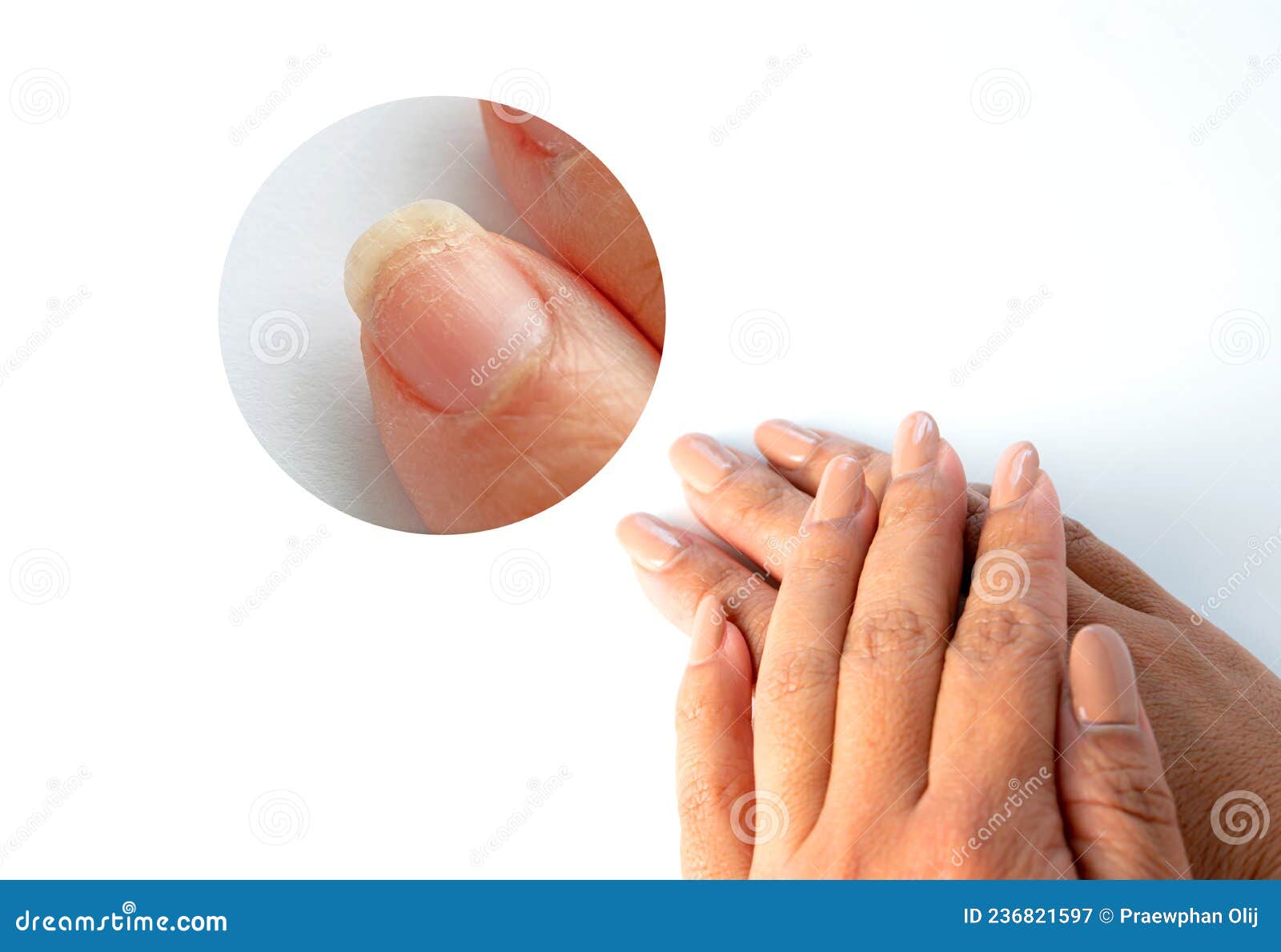 Dry Brittle Nails Royalty-Free Images, Stock Photos & Pictures |  Shutterstock