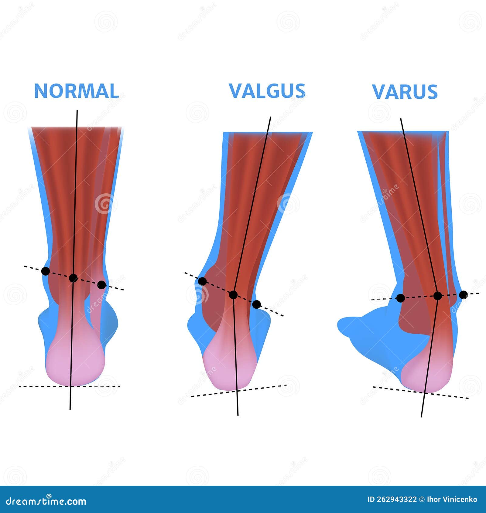 Female Jaw Deformities Of Mandibular Medical Poster Vector Illustration