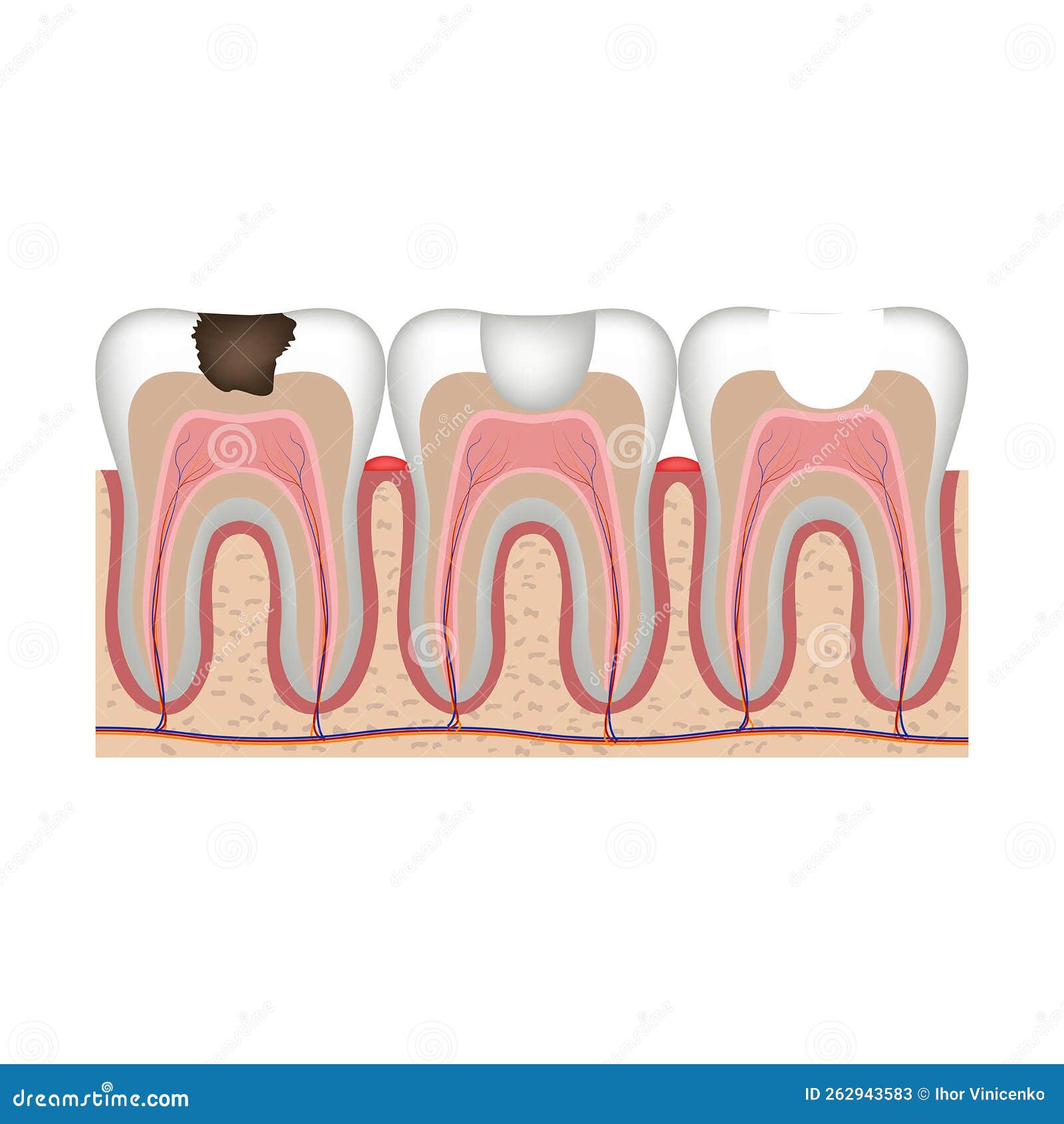 Caries. Stages Of Treatment Of A Tooth With A Filling. Cartoon Vector