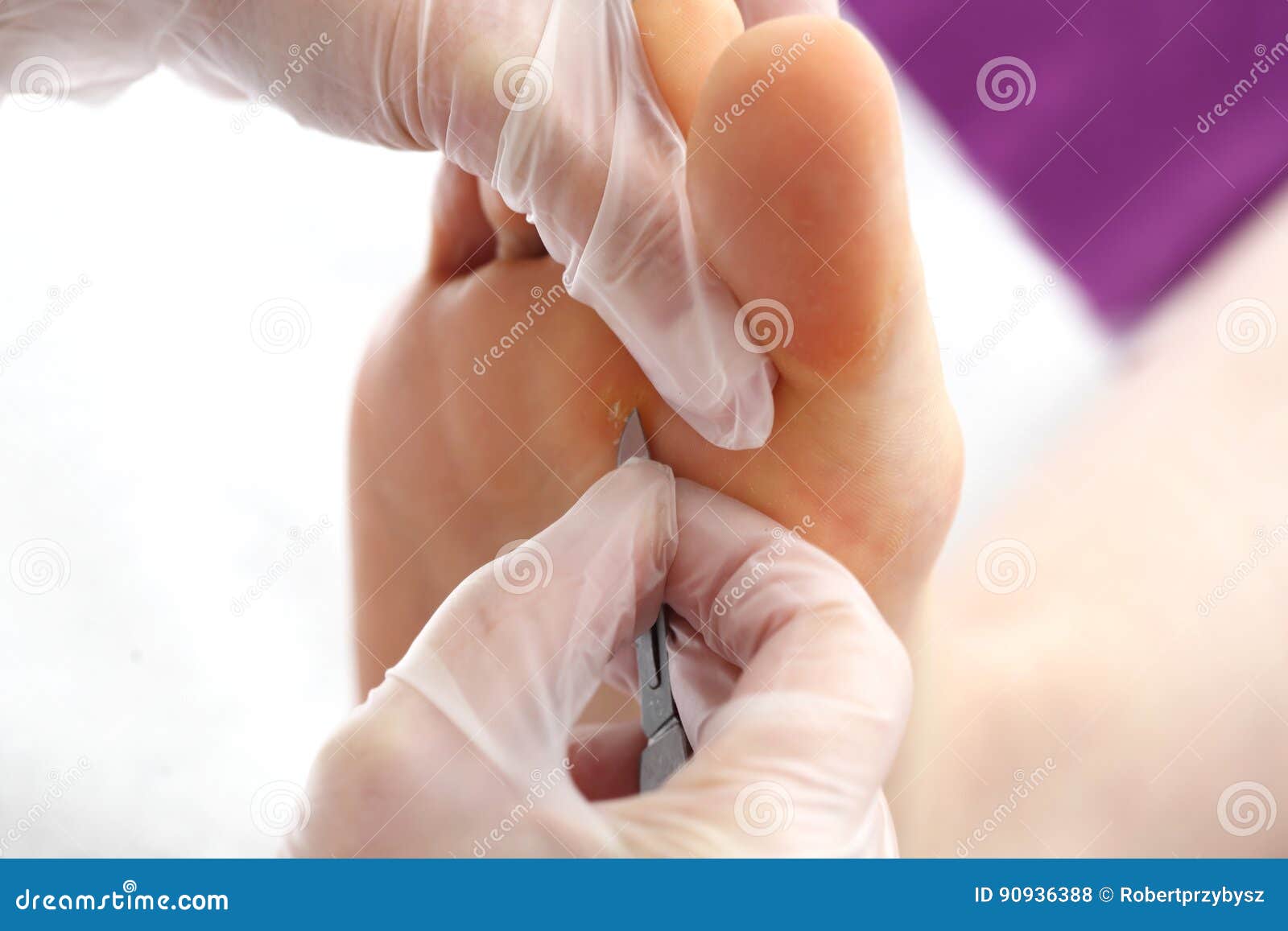 Κάλος στο πόδι. Ο γιατρός αφαιρεί τη σφραγίδα στο πόδι με ένα χειρουργικό νυστέρι