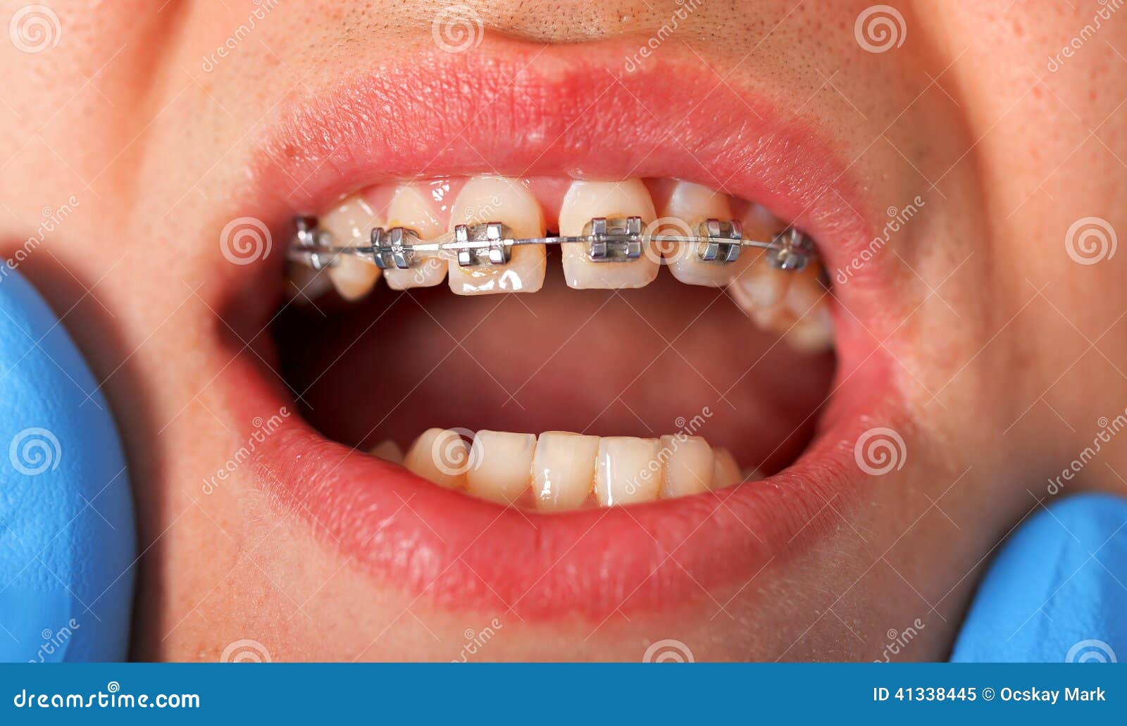 στηρίγματα οδοντικά. Κλείστε επάνω τα οδοντικά στηρίγματα σε μια οδοντική κλινική