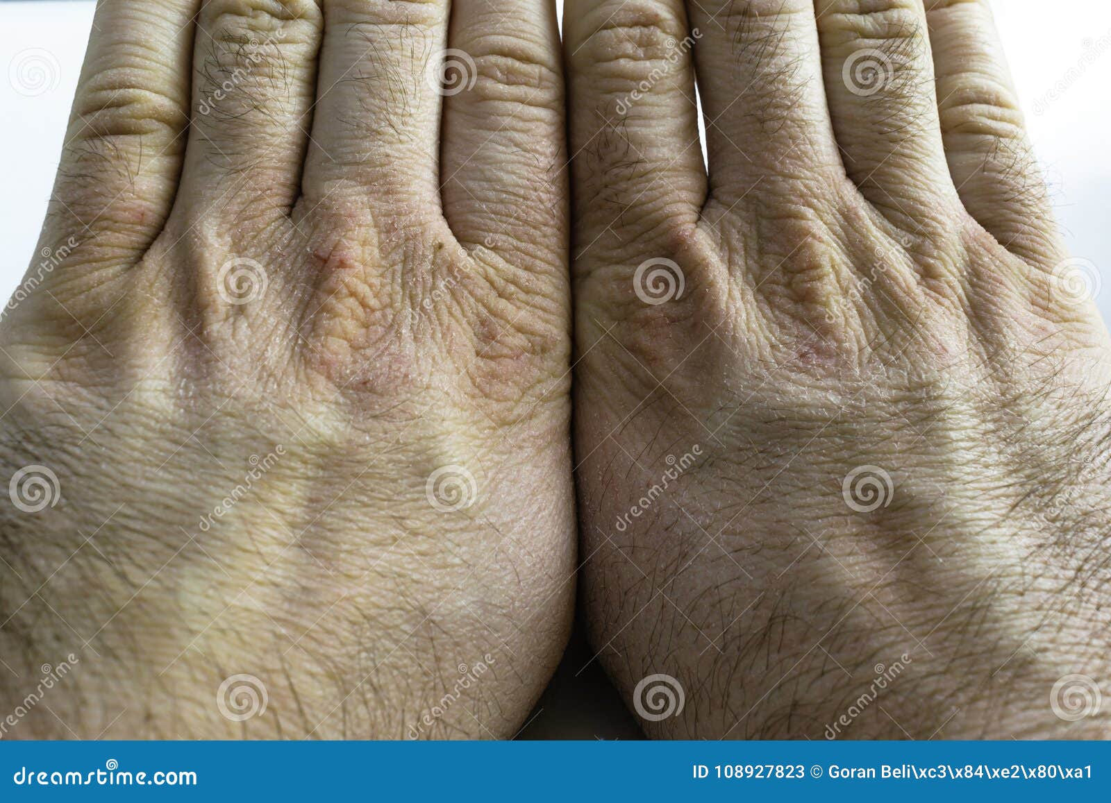 гангрена пальцев рук фото