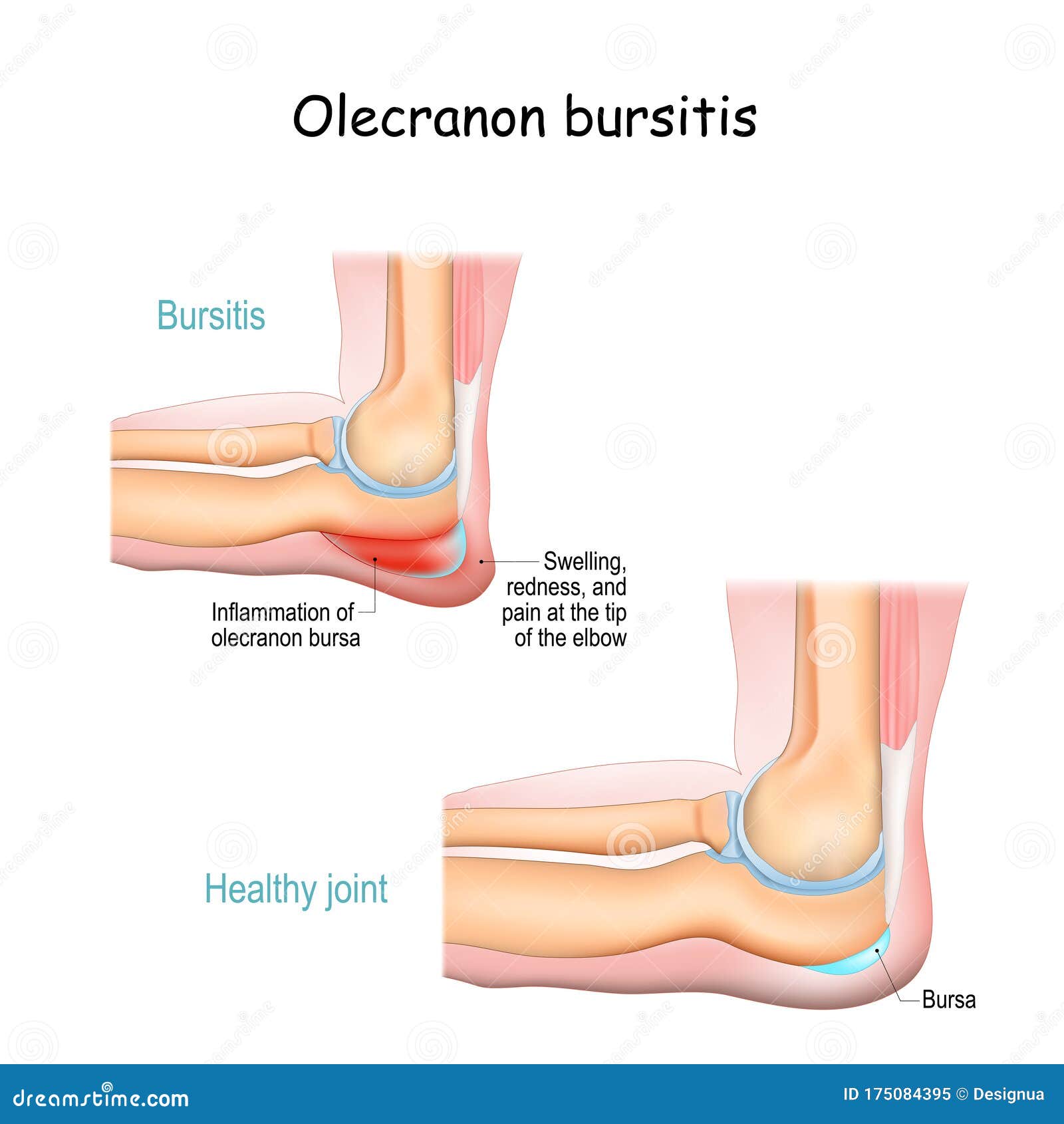 könyökízületi kezelési módszerek bursitis qigong az artrózis kezelésében
