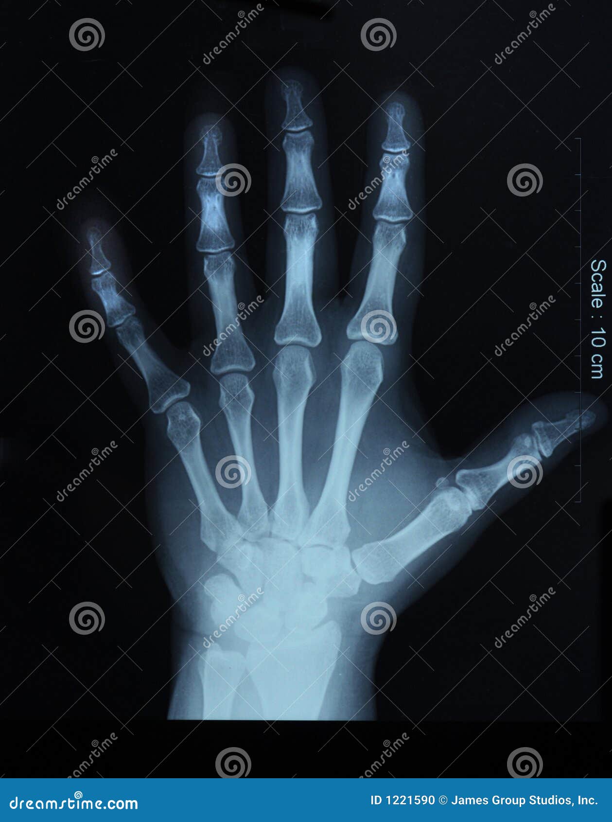 Остеопороз кистей рук рентген