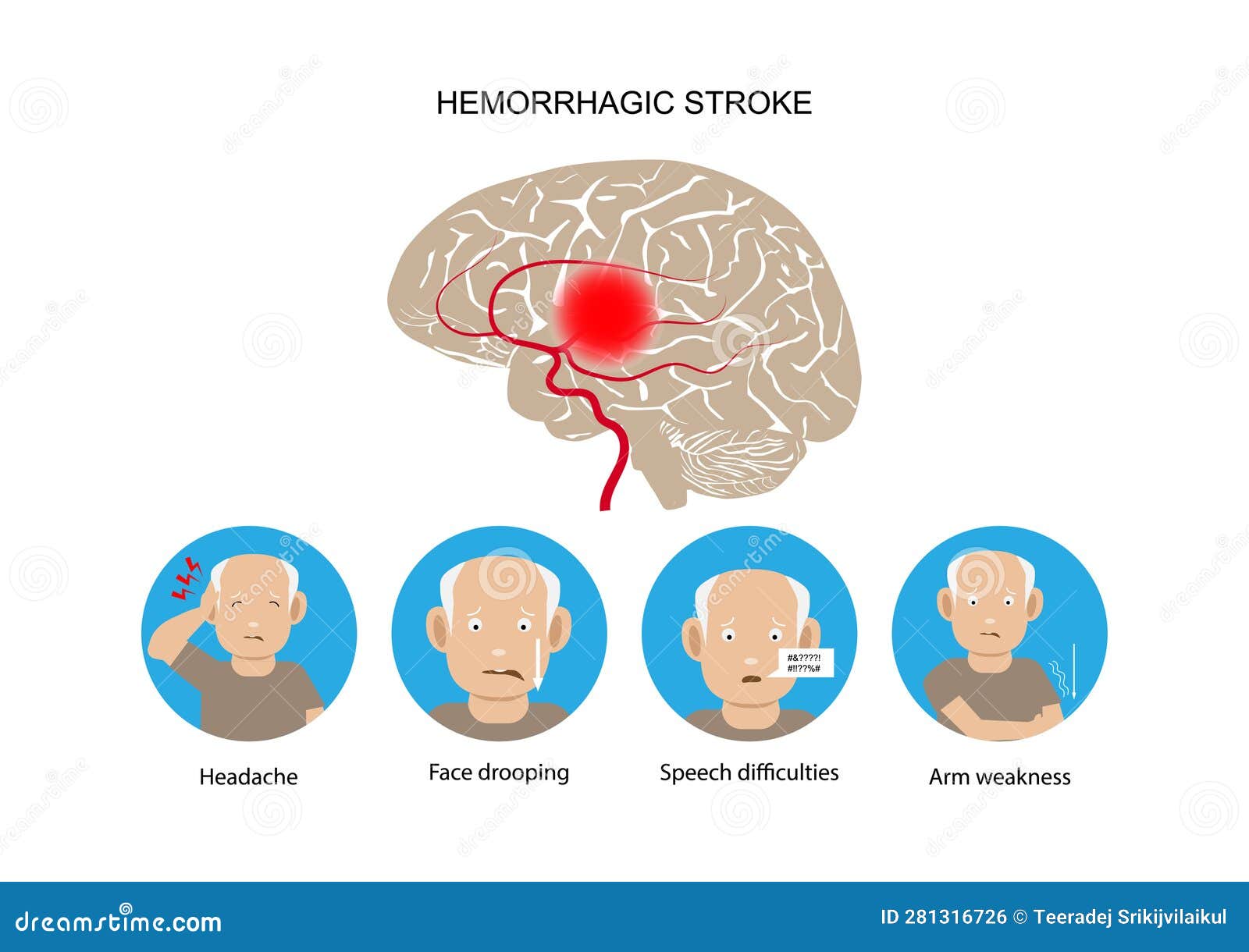 геморрагический инсульт и предупреждающие знаки и симптомы. Иллюстрация ...