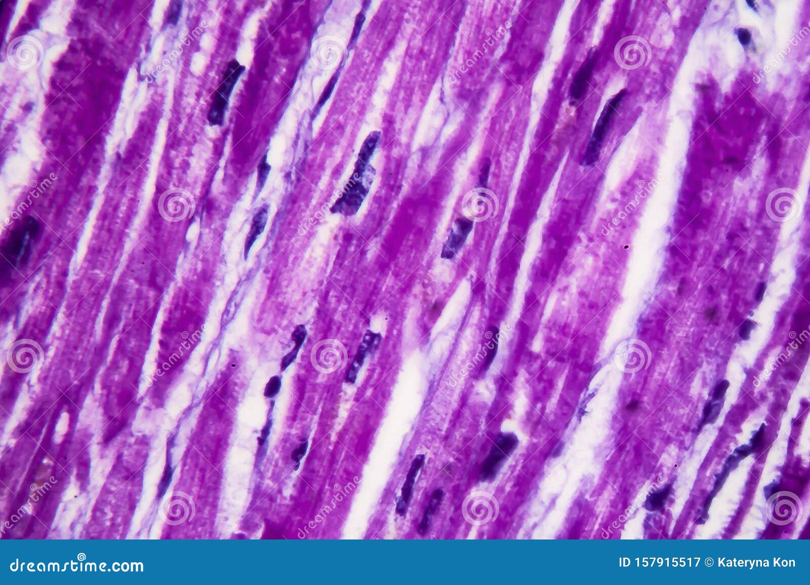 Гипертрофия сердца, легкий микрограф Стоковое Изображение - изображение ...