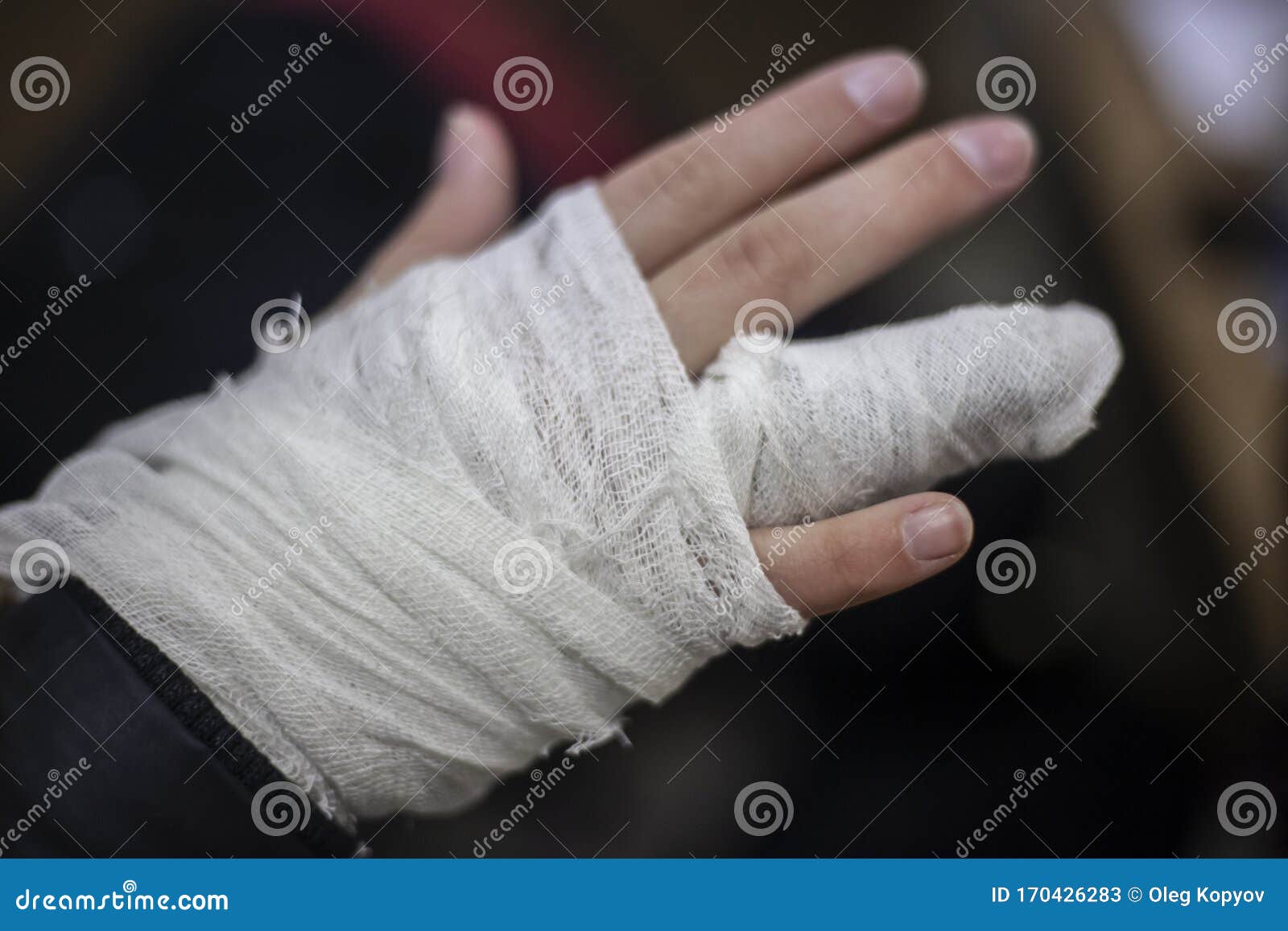 фото со сломанным пальцем