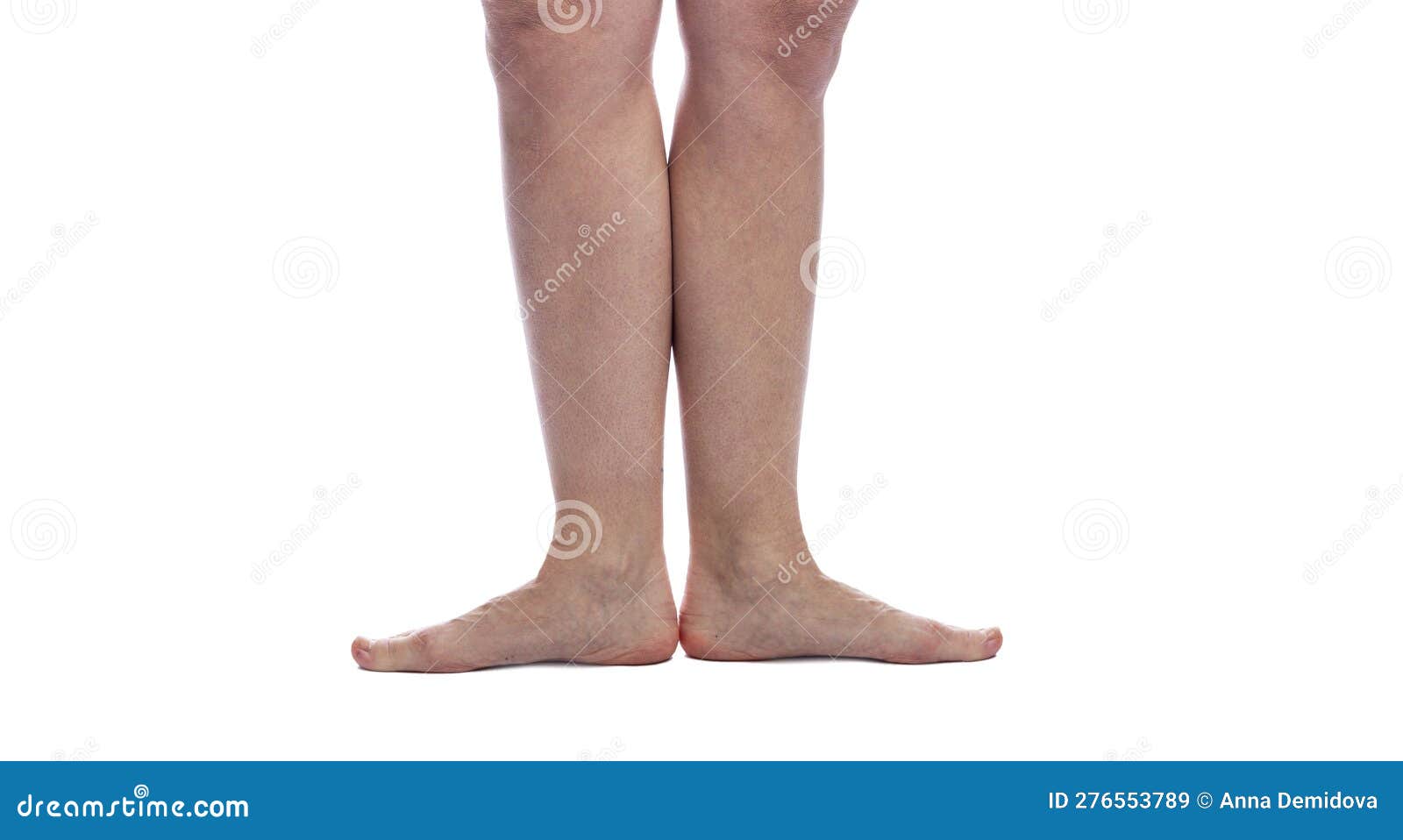 женская нога на колени с паутинными венами без лечения. проблемы ...