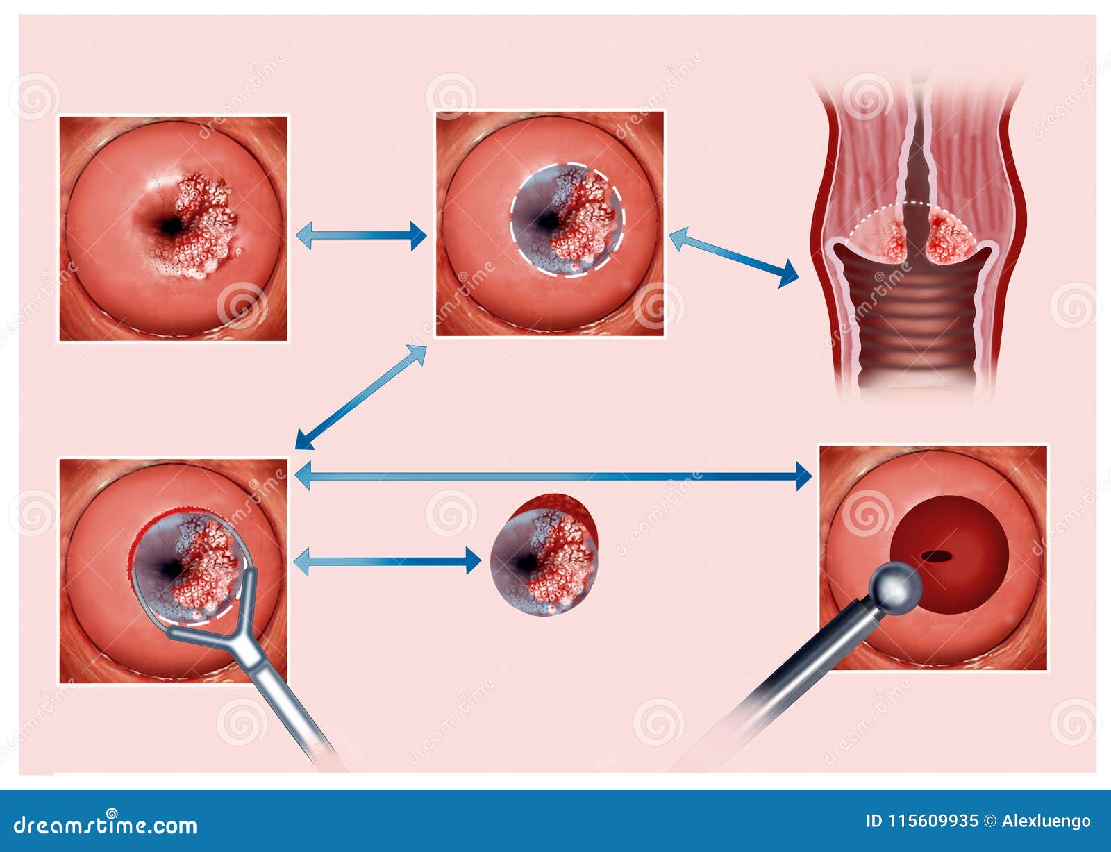 papilloma cauterization fórum