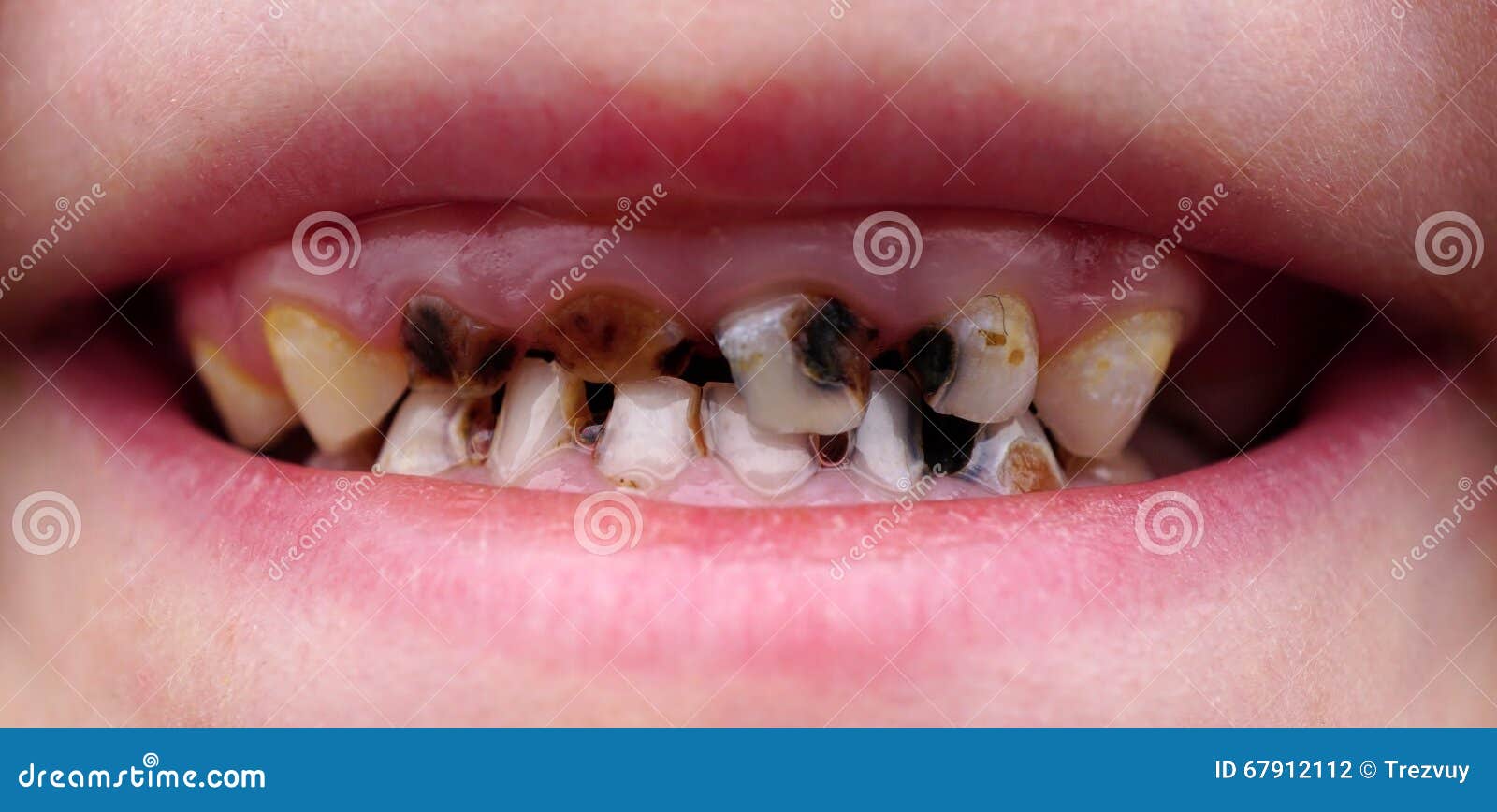 Костоеда на зубах ребенка