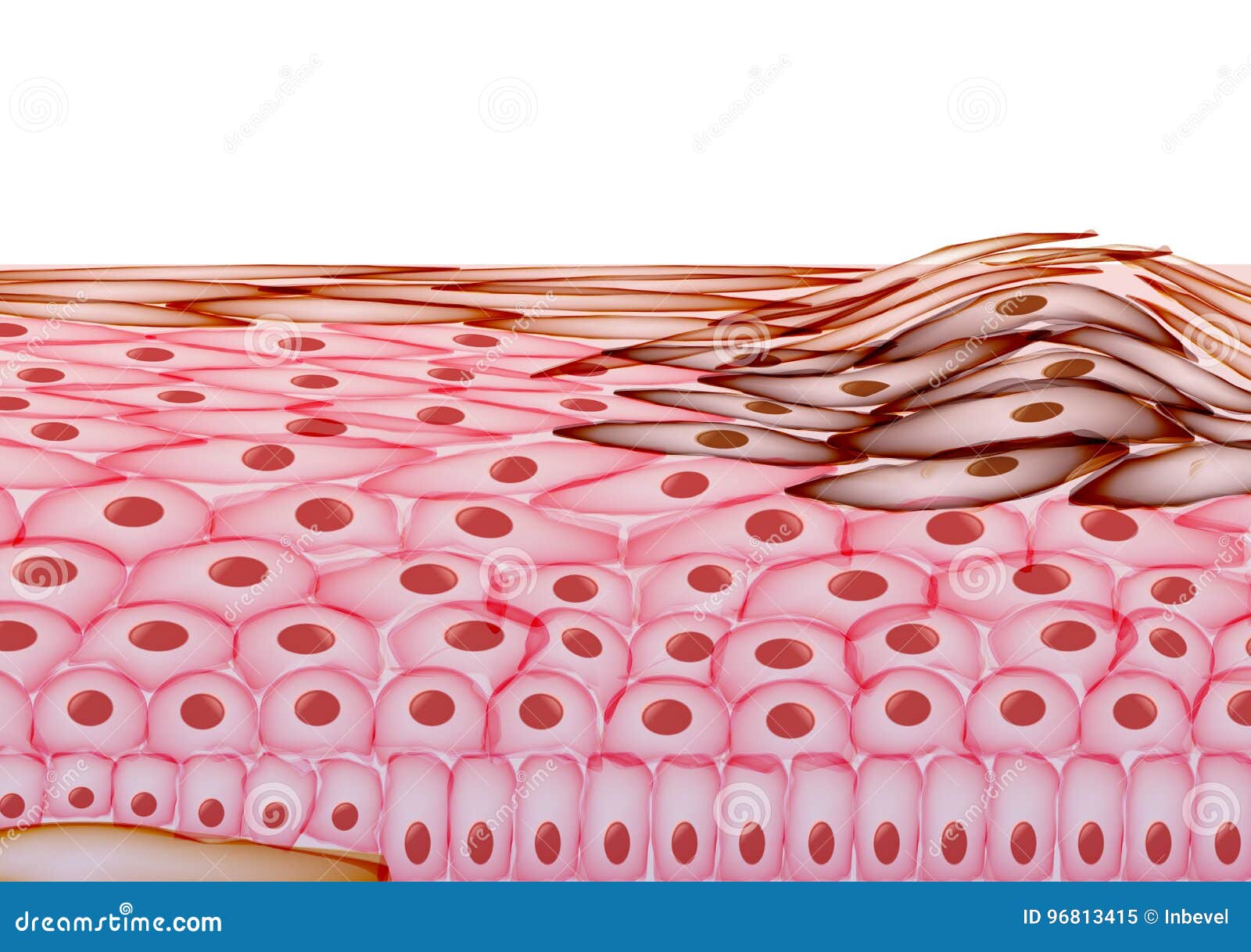 Меланома в слоях человеческой кожи, Карциномы - Vector Illustrati ...