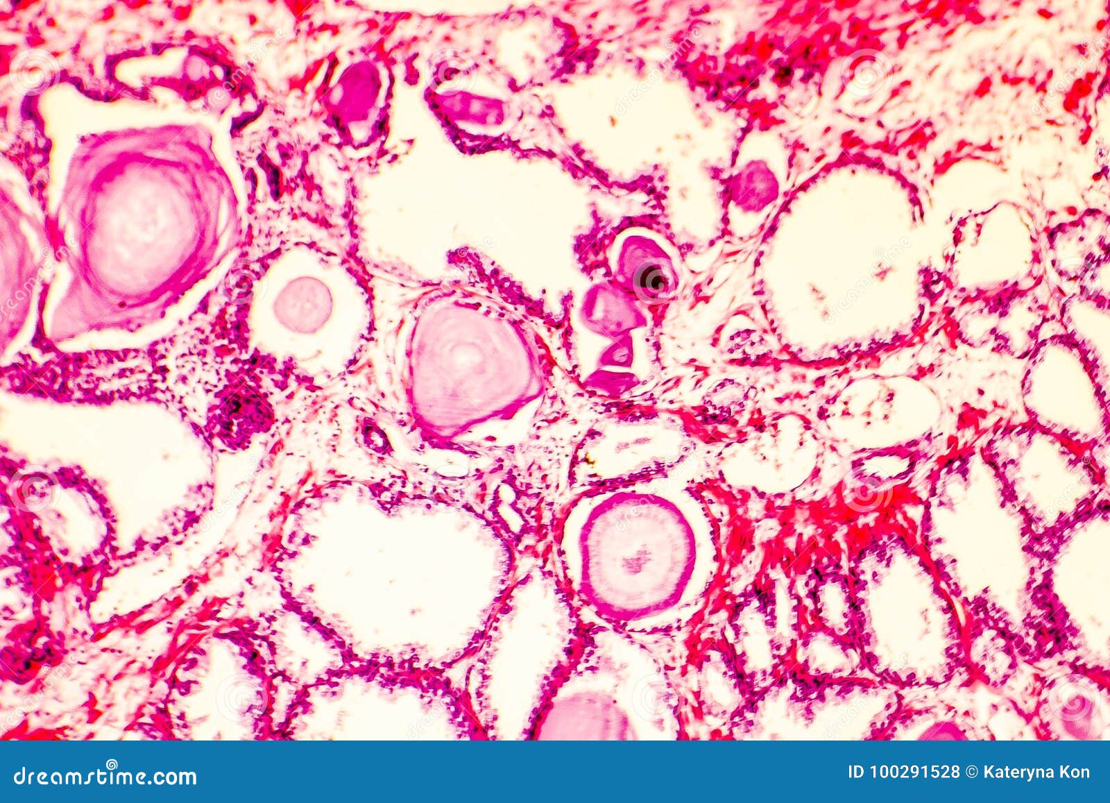 Микроснимок гиперплазии простаты Стоковое Фото - изображение ...