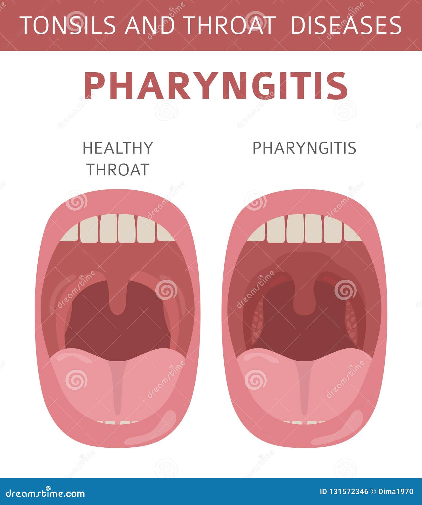 Болезни Горла Симптомы Фото — New-Freepik.Ru