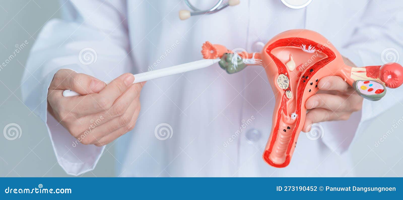 модель матки и яичников. эндометриоз истерэктомия рака шейки матки ...