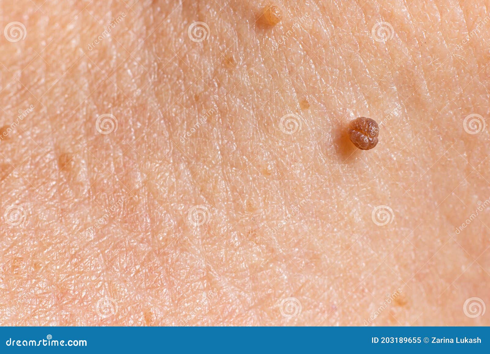l papillomatosis