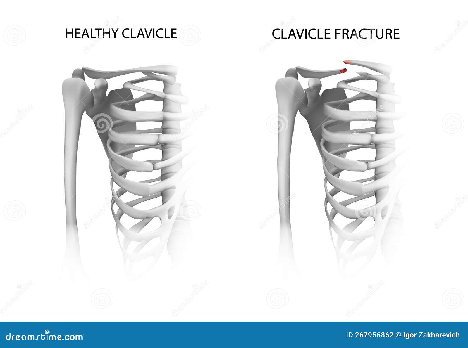 Healthy Collarbone. Clavicle Fracture Stock Illustration Illustration