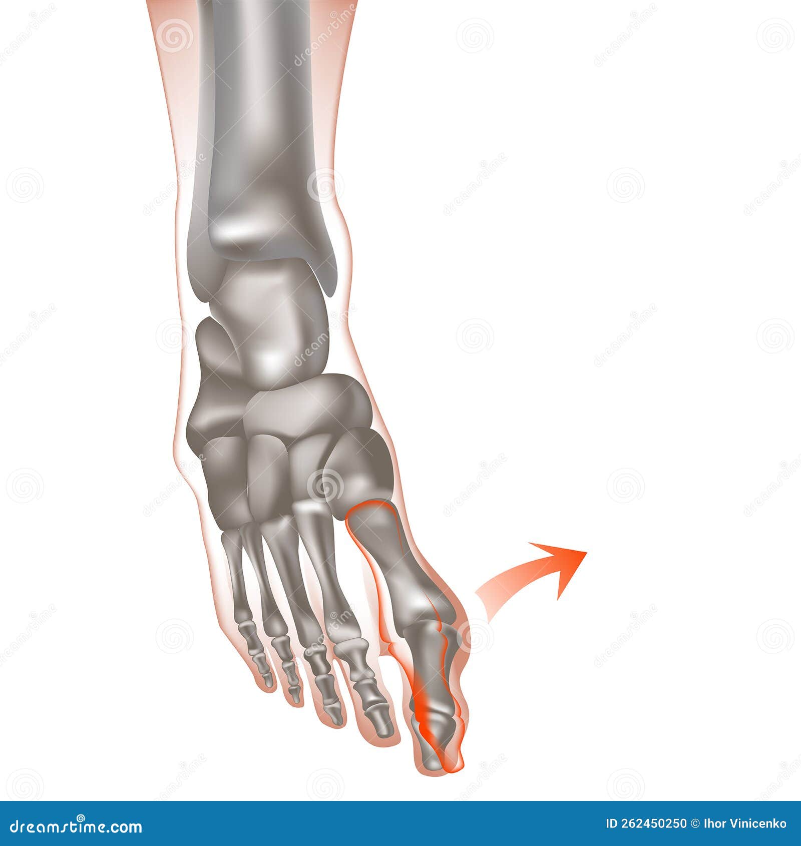 Valgus Deformity of the Big Toe. Bones on the Feet or Bumps on the Feet