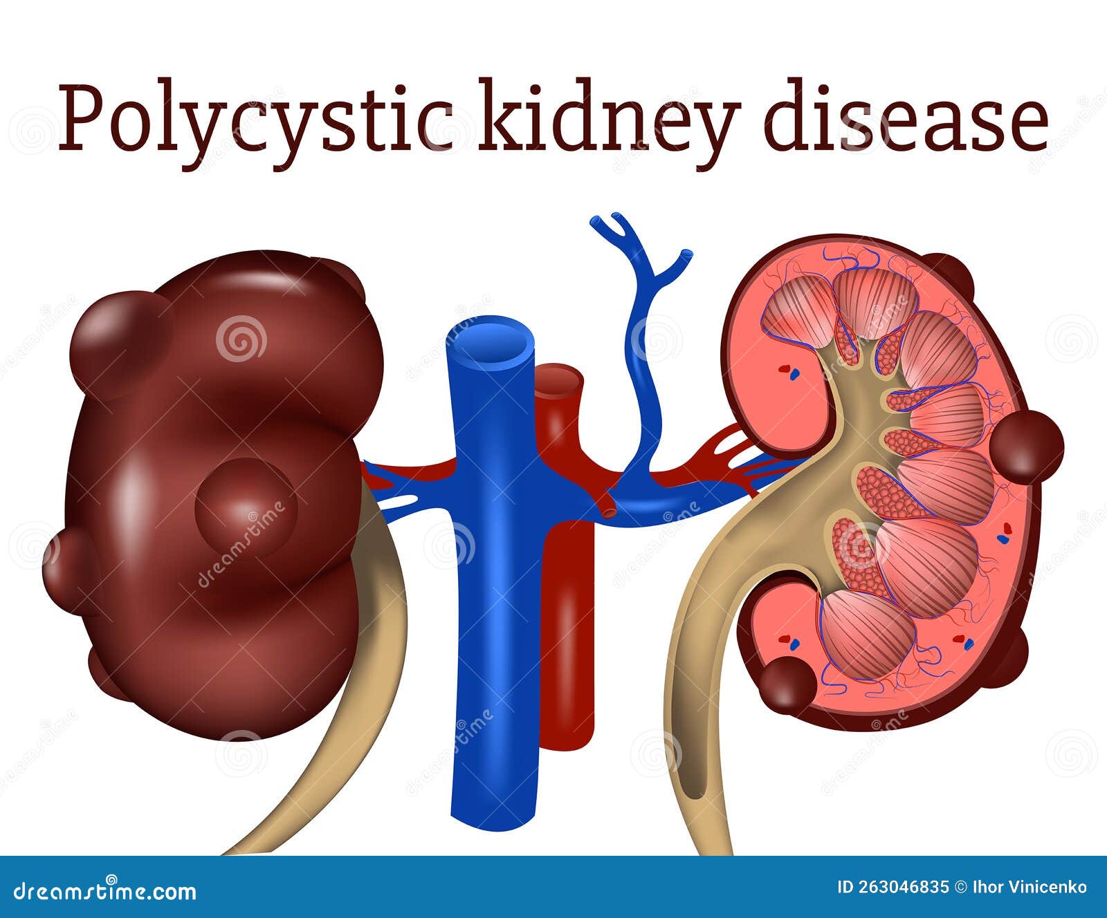 Polycystic Kidney Disease. Disease Stock Vector Illustration