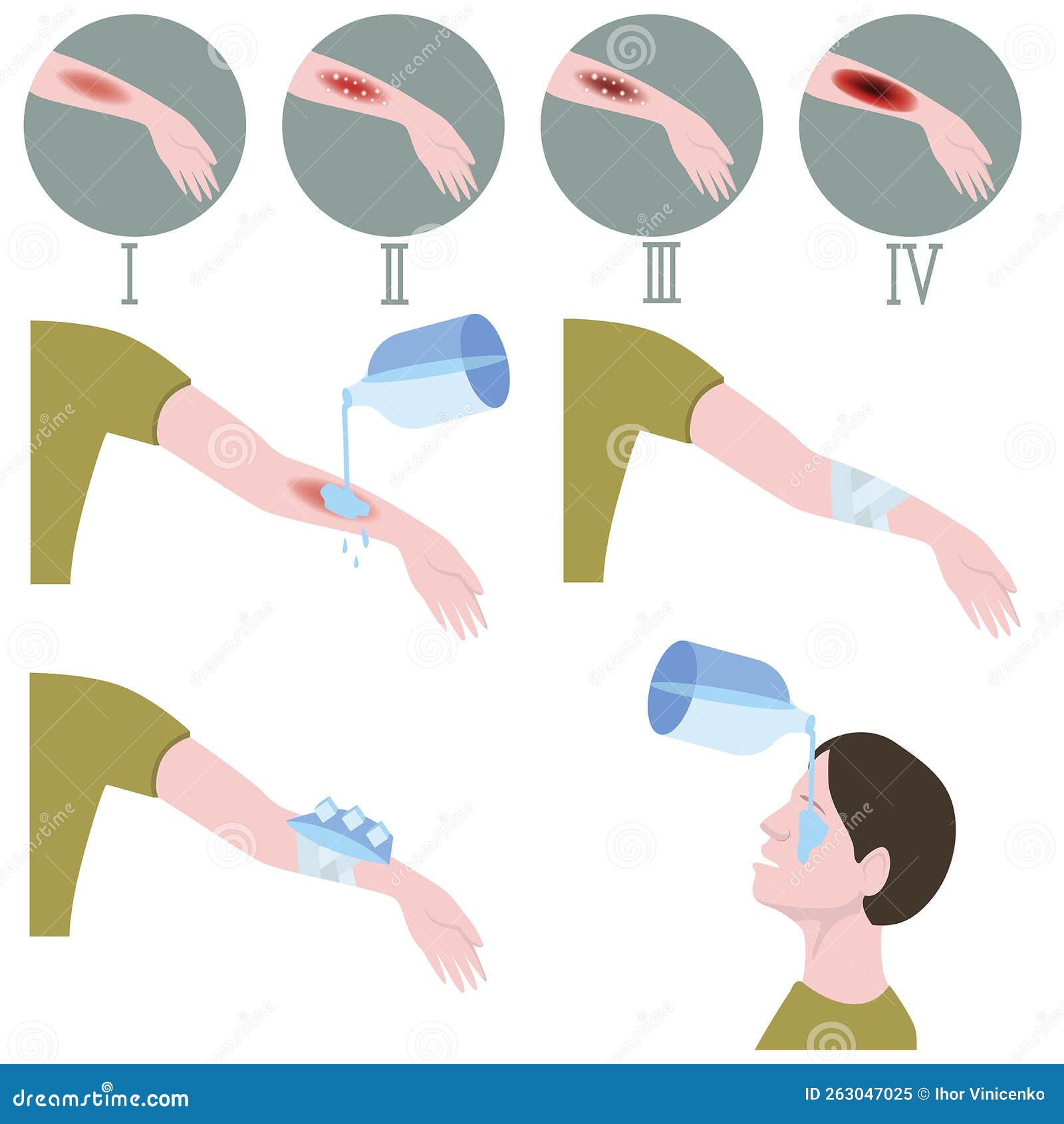 Burn Stages. First Aid for Thermal Injuries of the Body and Fires Stock Vector Illustration of