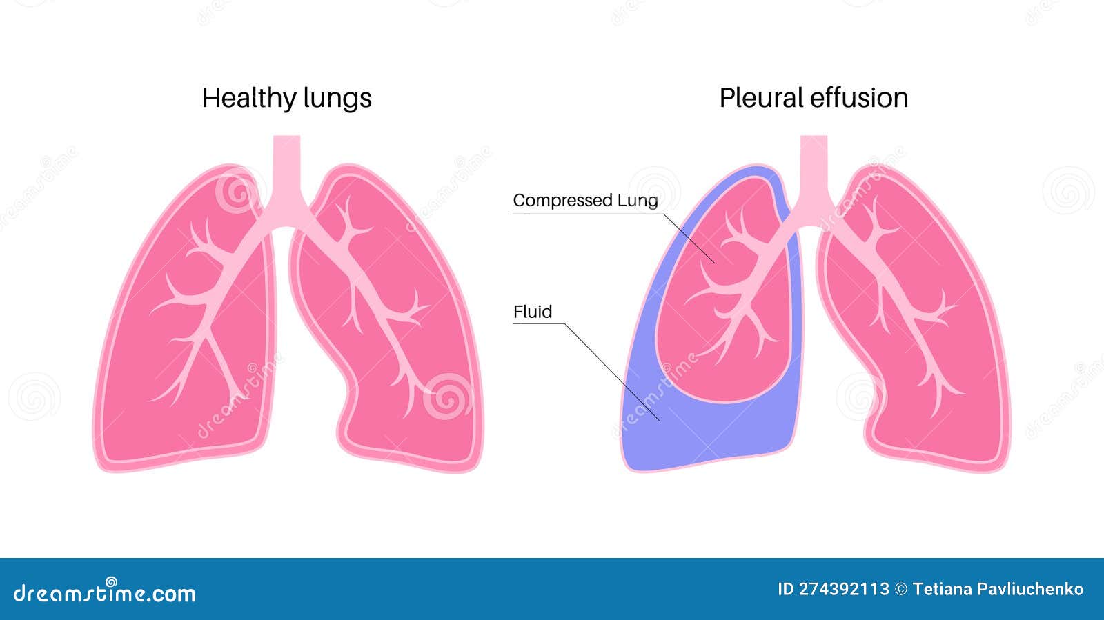 плакат о плевральном эффекте Иллюстрация вектора - иллюстрации ...