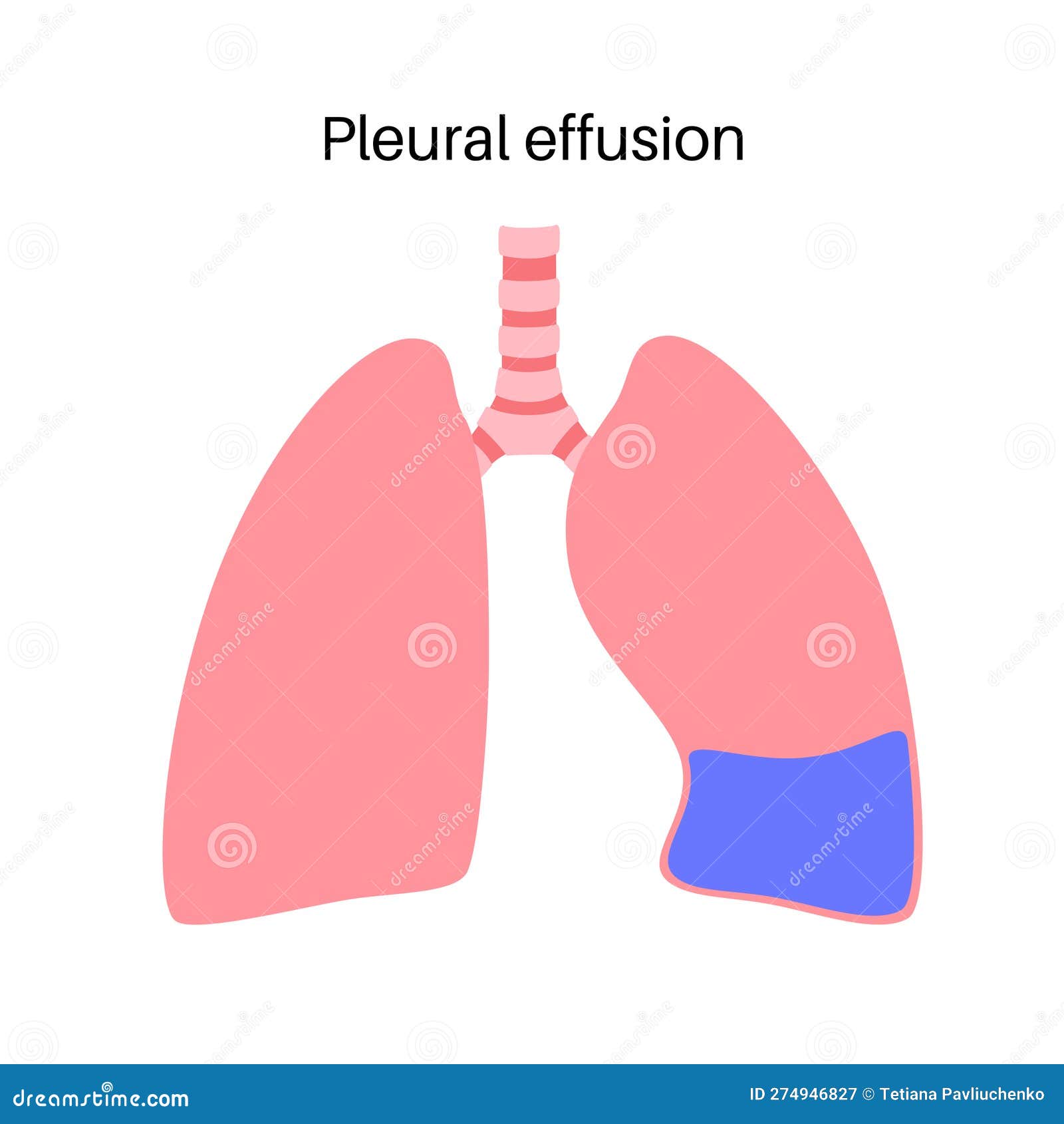 плакат о плевральном эффекте Иллюстрация вектора - иллюстрации ...