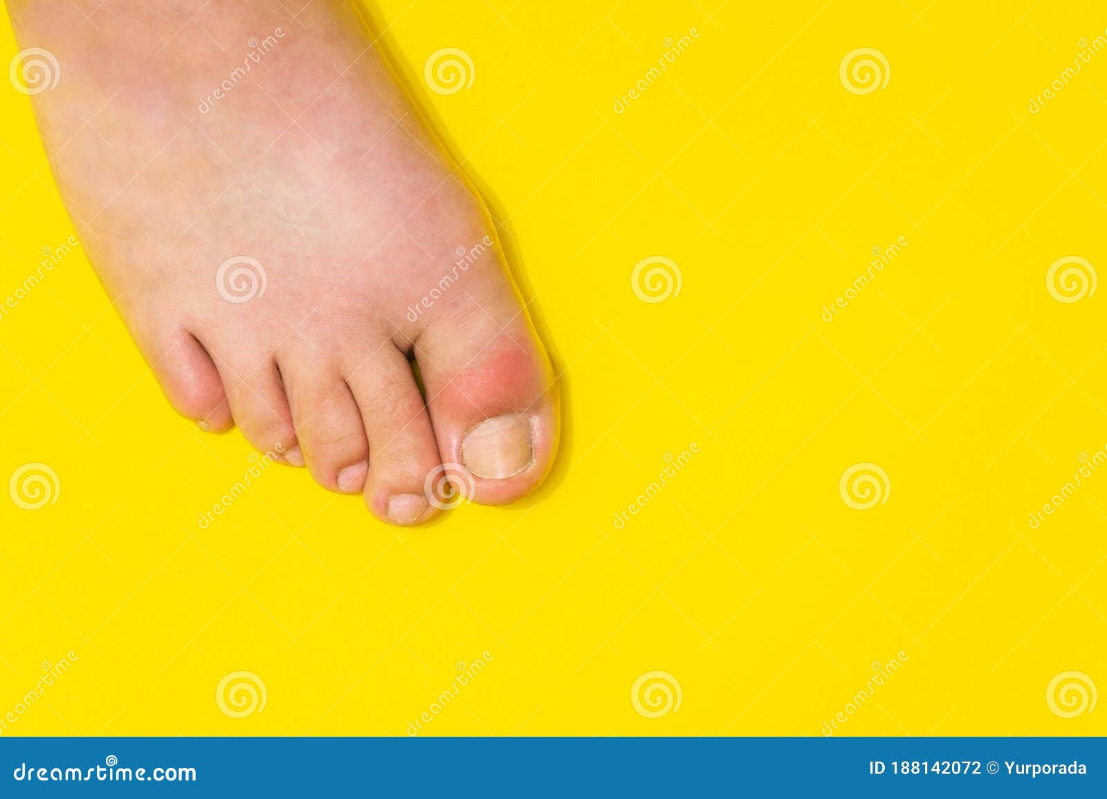 Подагра на большом пальце ноги выглядит как покраснение и невыносимая ...