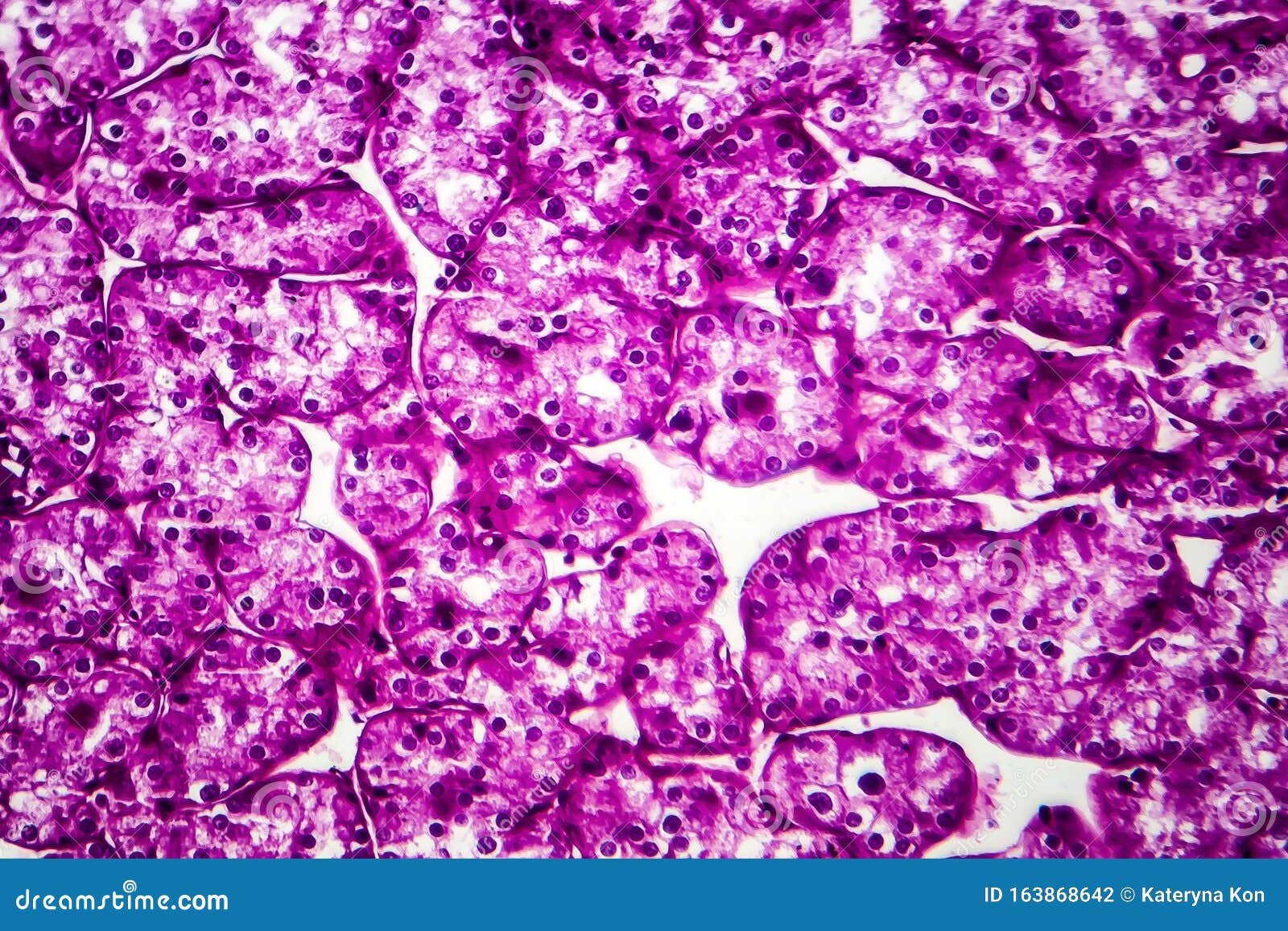 Рак почки, легкий микрограф Стоковое Фото - изображение насчитывающей ...