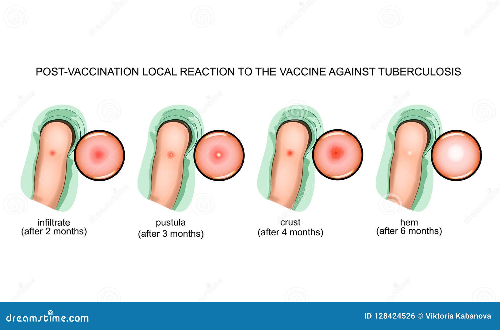 Vaccination against tuberculosis