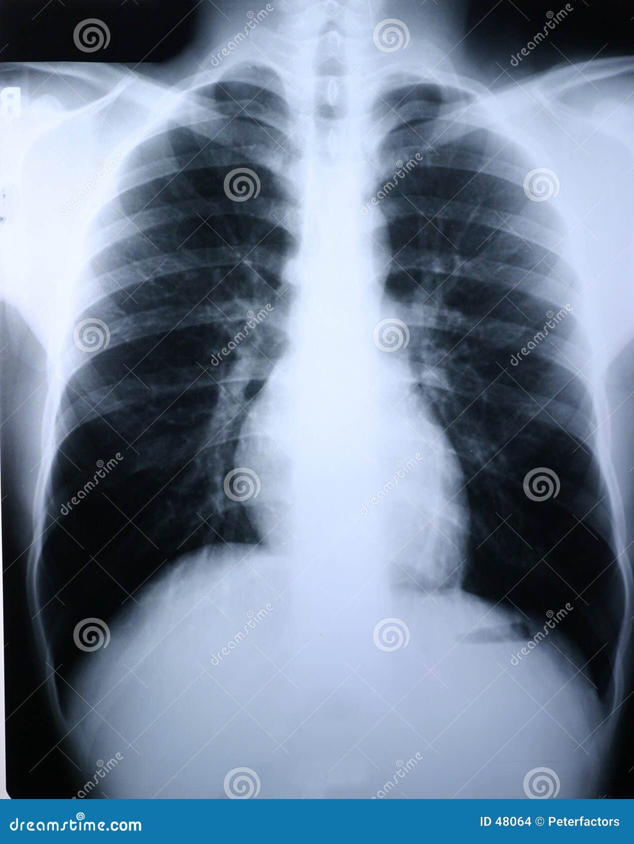 рентгеновский снимок легкя