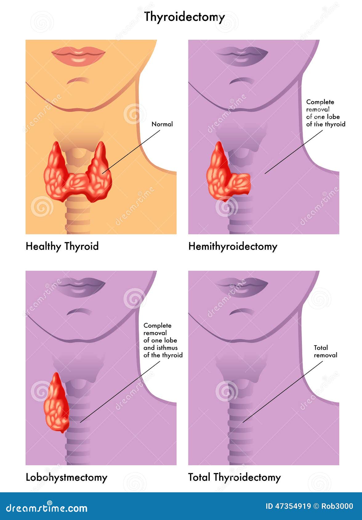Тиреоидэктомия иллюстрация вектора. иллюстрации насчитывающей система ...