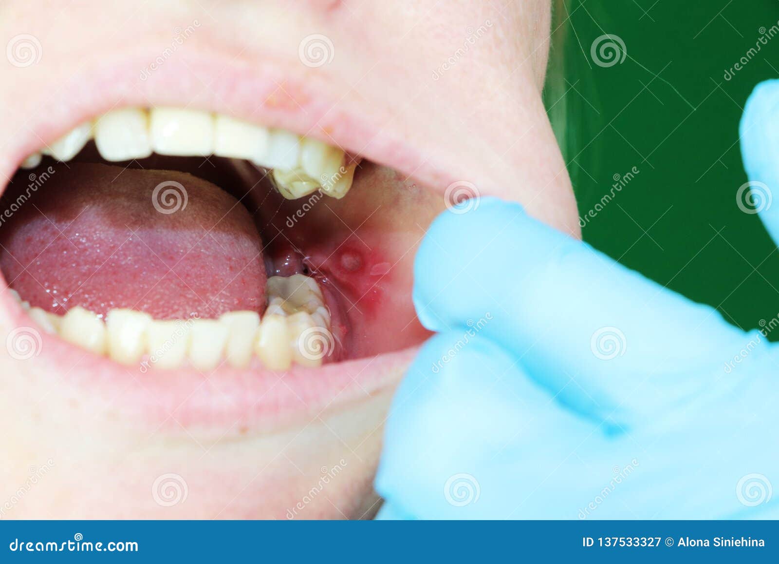 Тягостные гнойник и стоматит на слизовой щеке девушки После ...