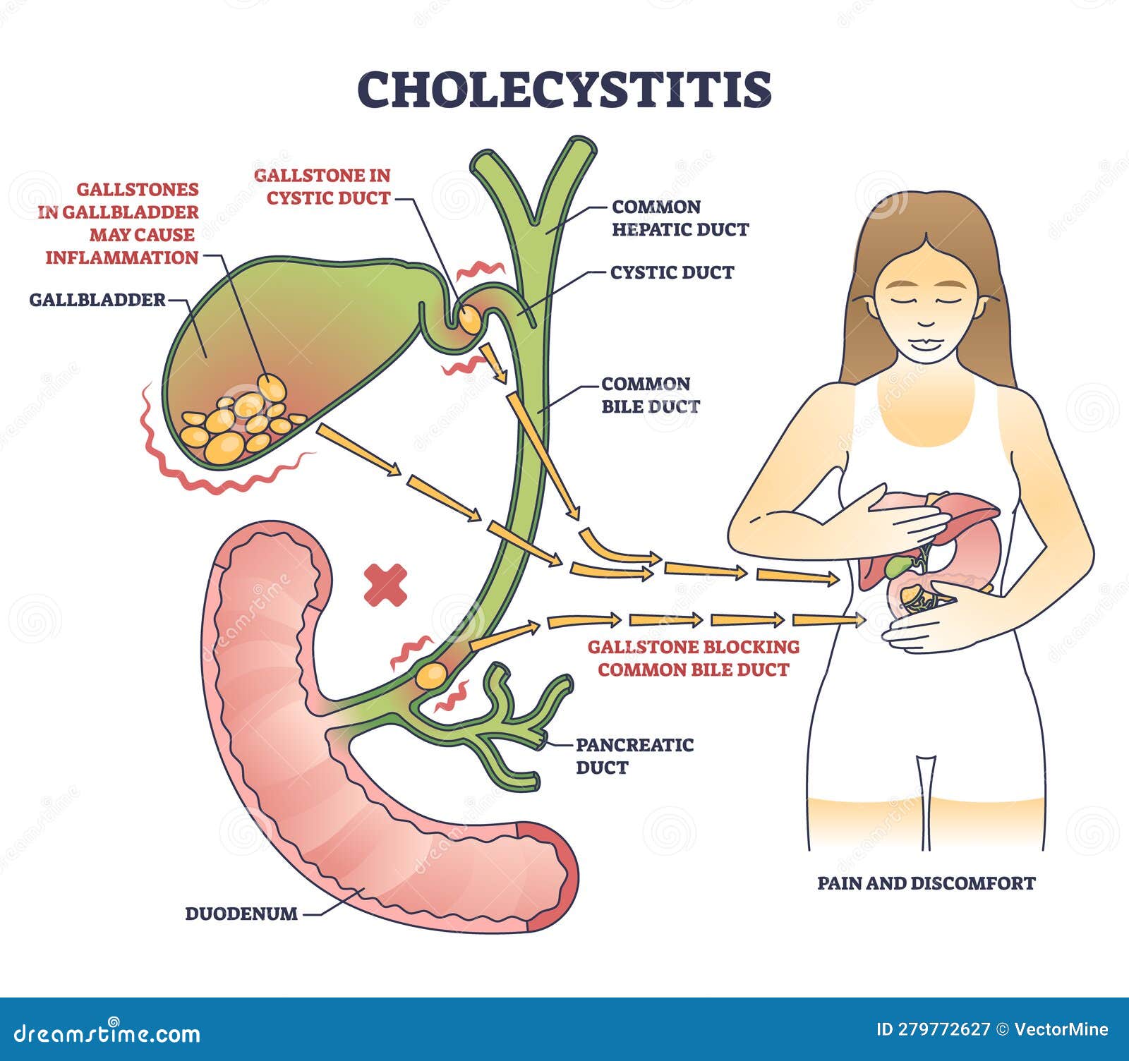 холецистит как воспаление желчного пузыря на схеме схемы Иллюстрация ...