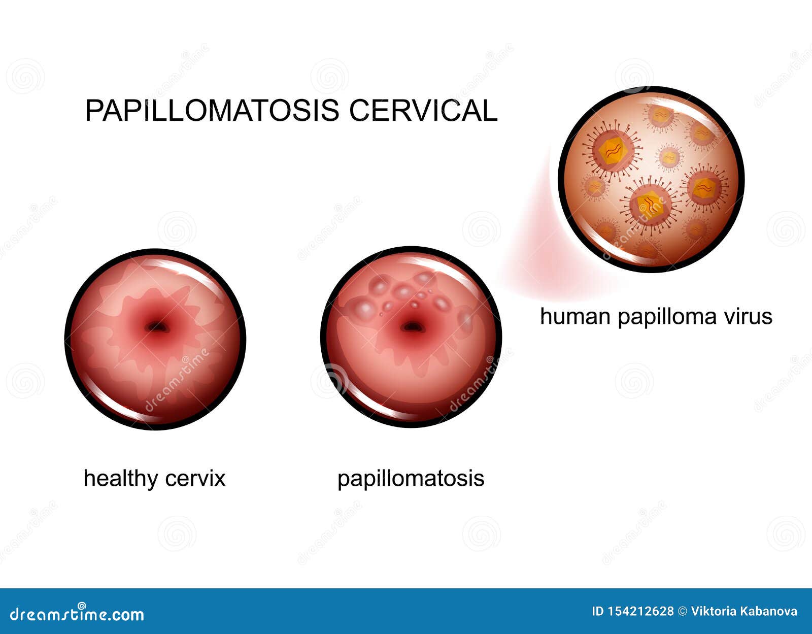 HPV-szűrés és tipizálás - weba.lt
