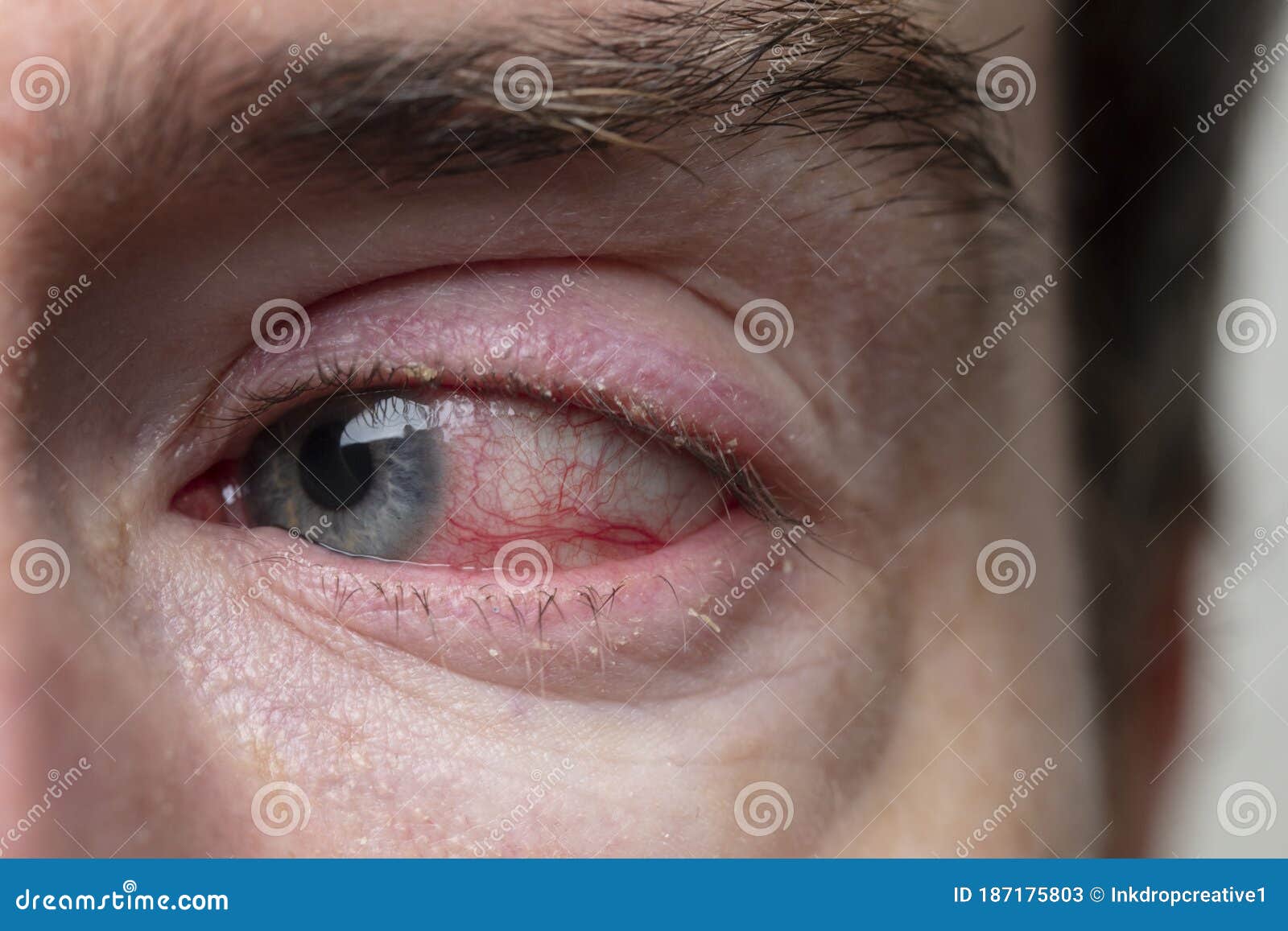 眼睛发红。结膜炎的症状，过敏，眼睛发炎。眼睛发红图标。信息图。矢量插图在孤立的背景。插画图片素材_ID:352755729-Veer图库