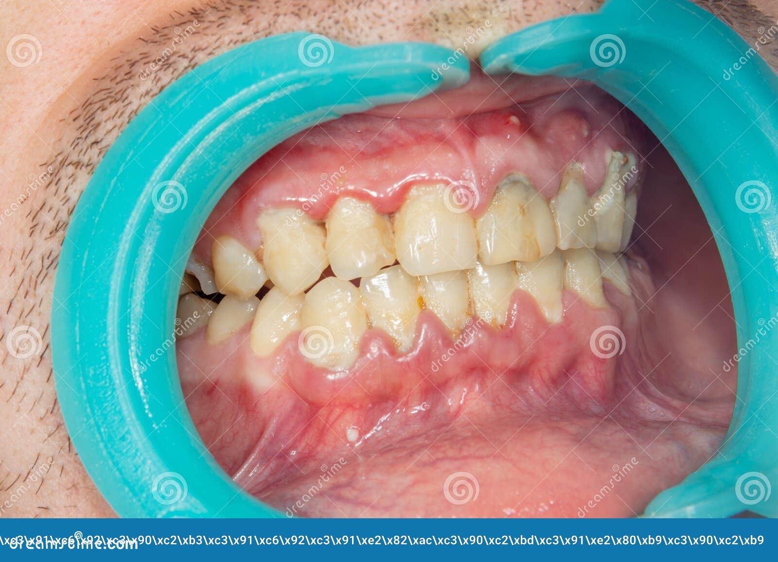 警惕：牙菌斑危害大，中老年人首当其冲！