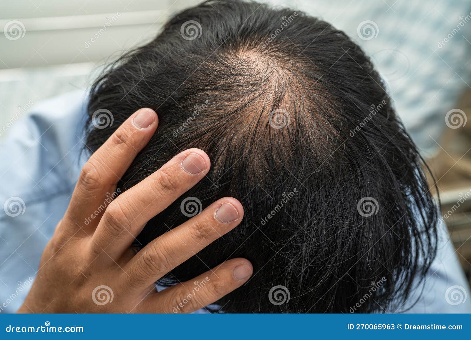 秃顶男子自称半个月不用洗发水长出新头发，专家紧急提醒_男子秃顶半月不用洗发水后长出头发_王先生_医生
