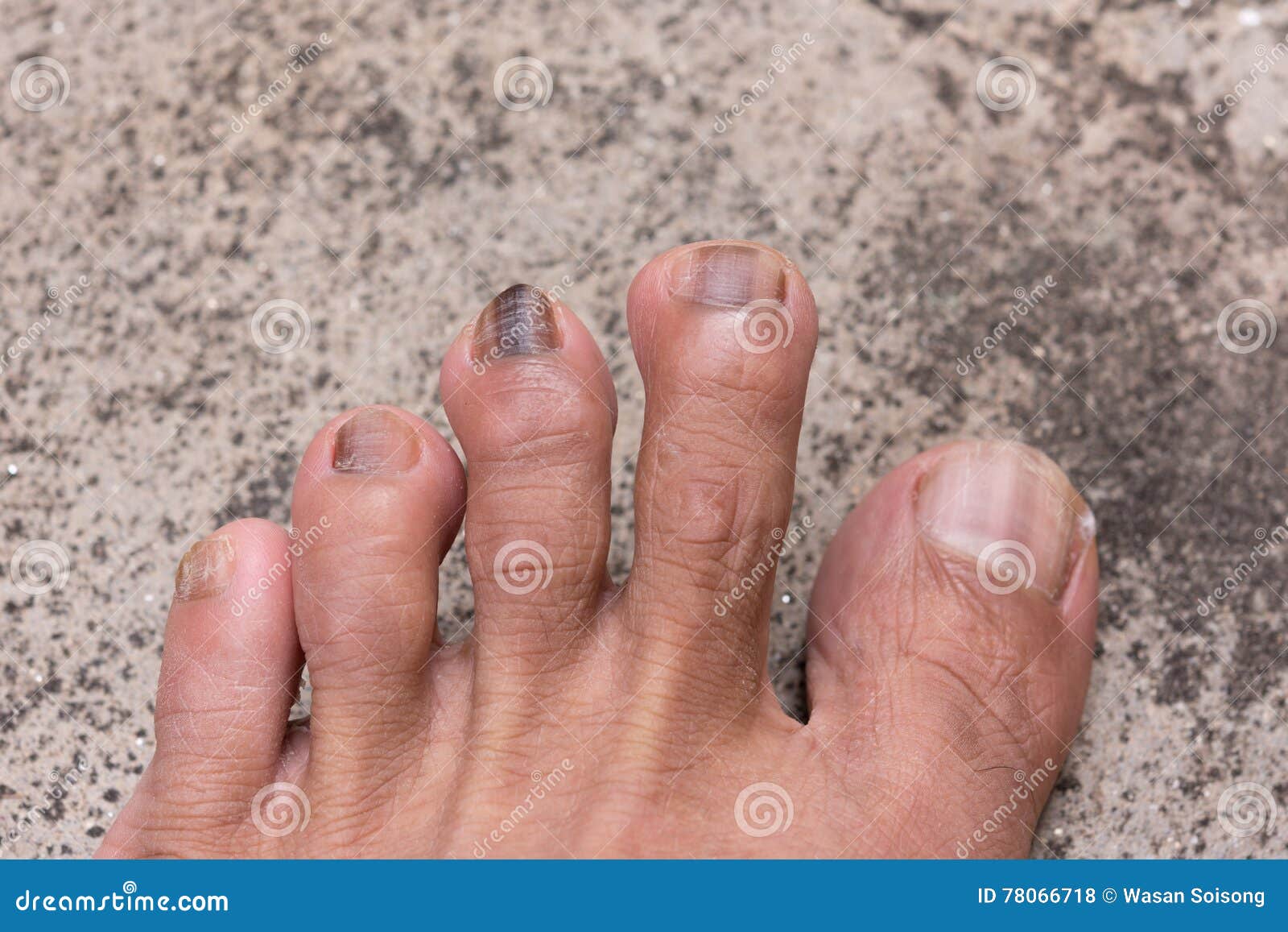 因为儿童` S异常的钉子可能告诉疾病的症状医生检查患者` S脚趾钉子那个孩子 库存照片 - 图片 包括有 核对, 皮炎: 99443206