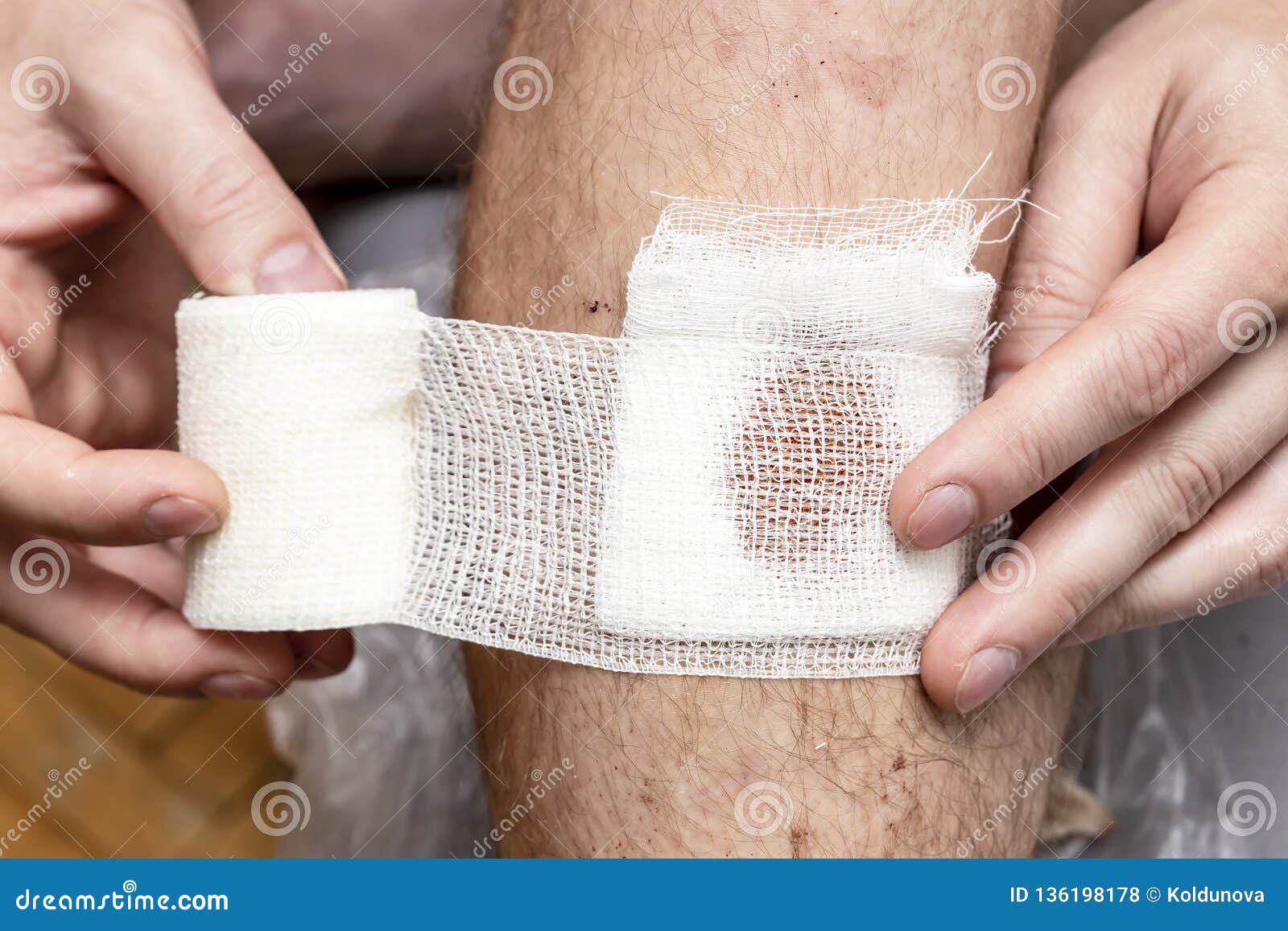 膝盖摔伤，抹了碘伏结痂后如何防止留疤？ - 知乎
