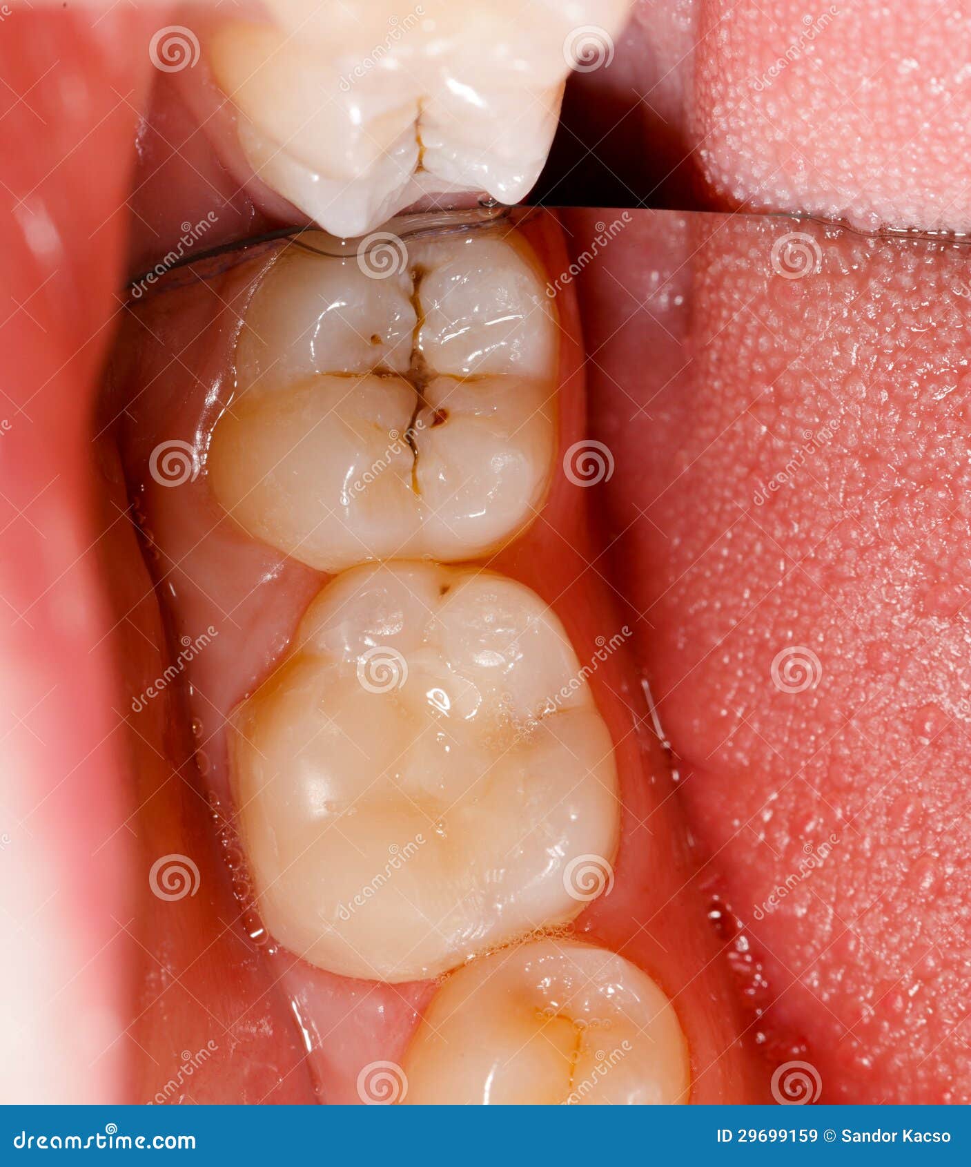 牙齿上的黑洞千万不能忽视！！！记录一下人生中第一次补牙的经历~ - 知乎