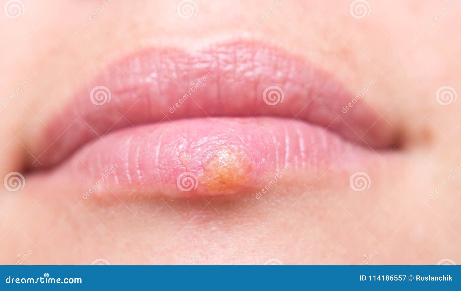 嘴唇上出现疱疹病症的妇女. 病毒感染的治疗 库存照片. 图片 包括有 成人, 伤害, 不适, 憎恶, 生了酒垢 - 232502918