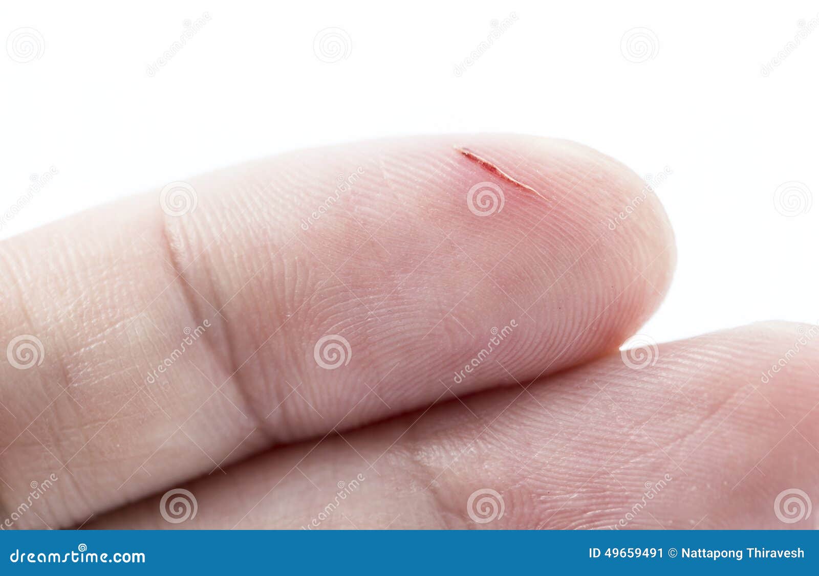Injured Finger with Bloody Bandage Stock Image - Image of body, hand: 44081865