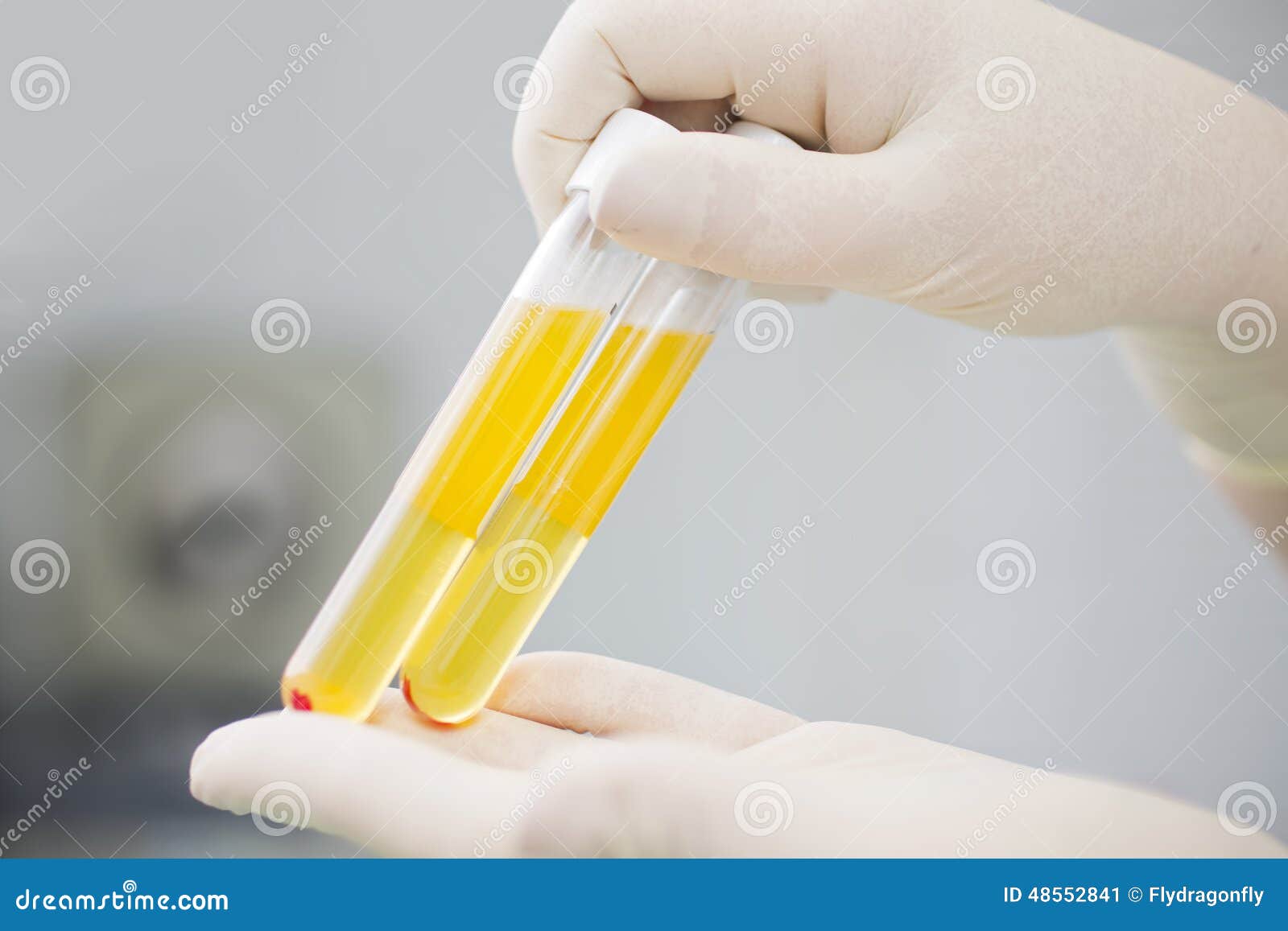 在试管的血浆plasmalifting的